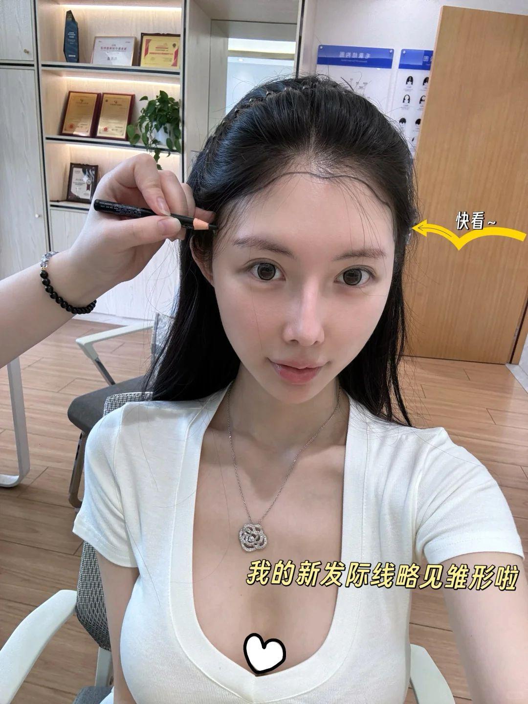 不剃发植发 植发手术 3