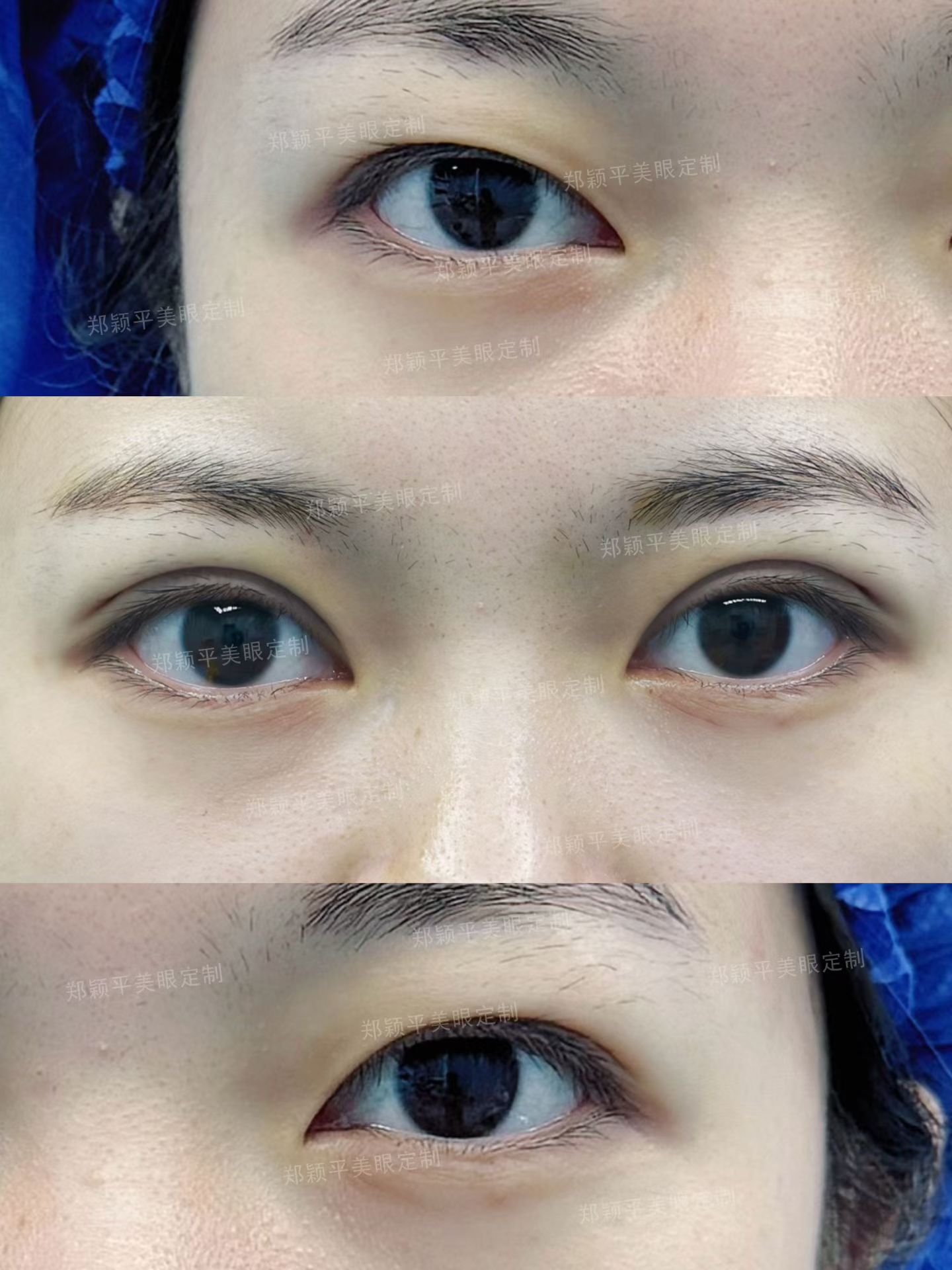 甜美柔和平行双眼皮即刻效果反馈 1