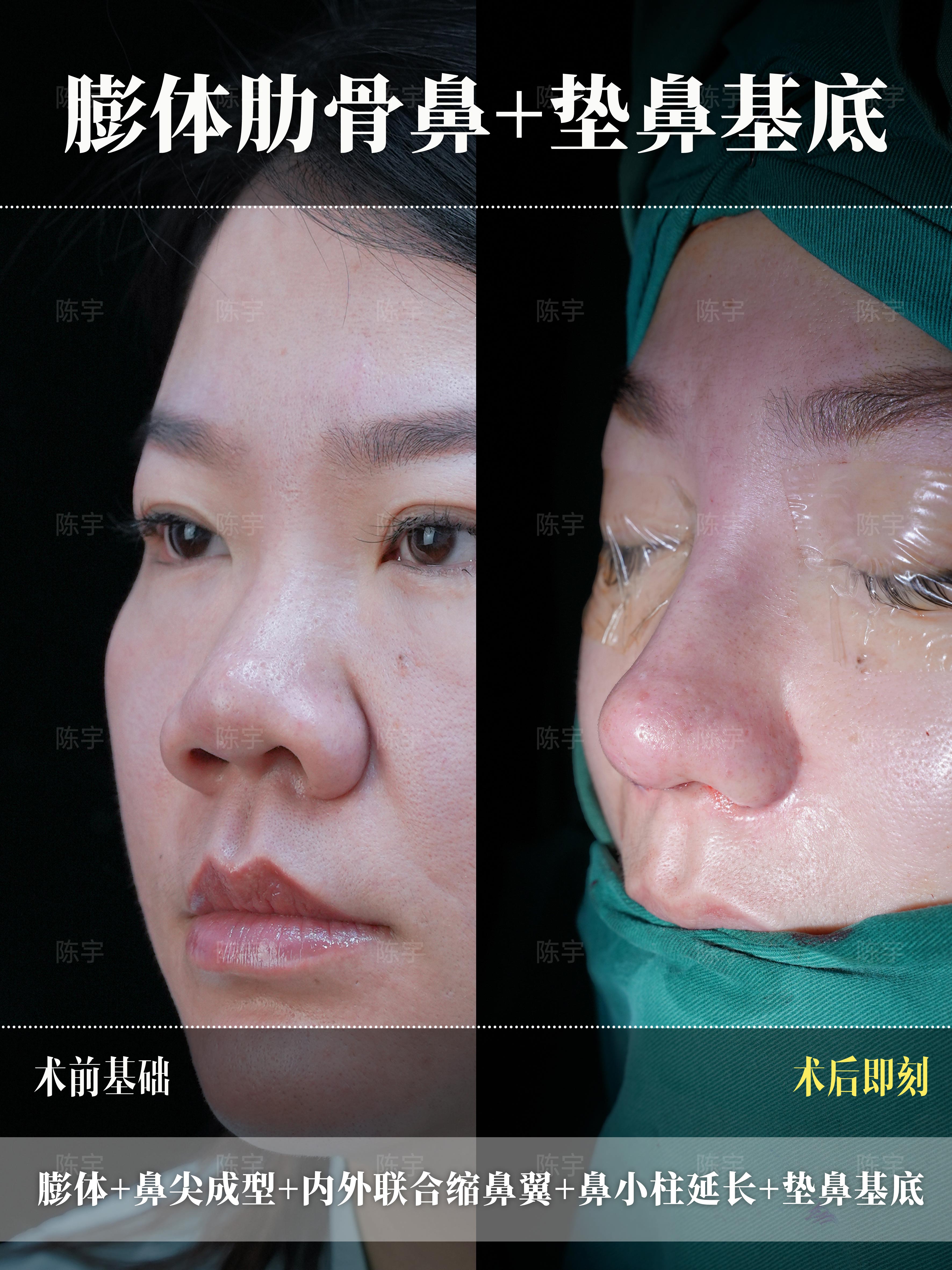 蒜头鼻 鼻综合改善👃 2