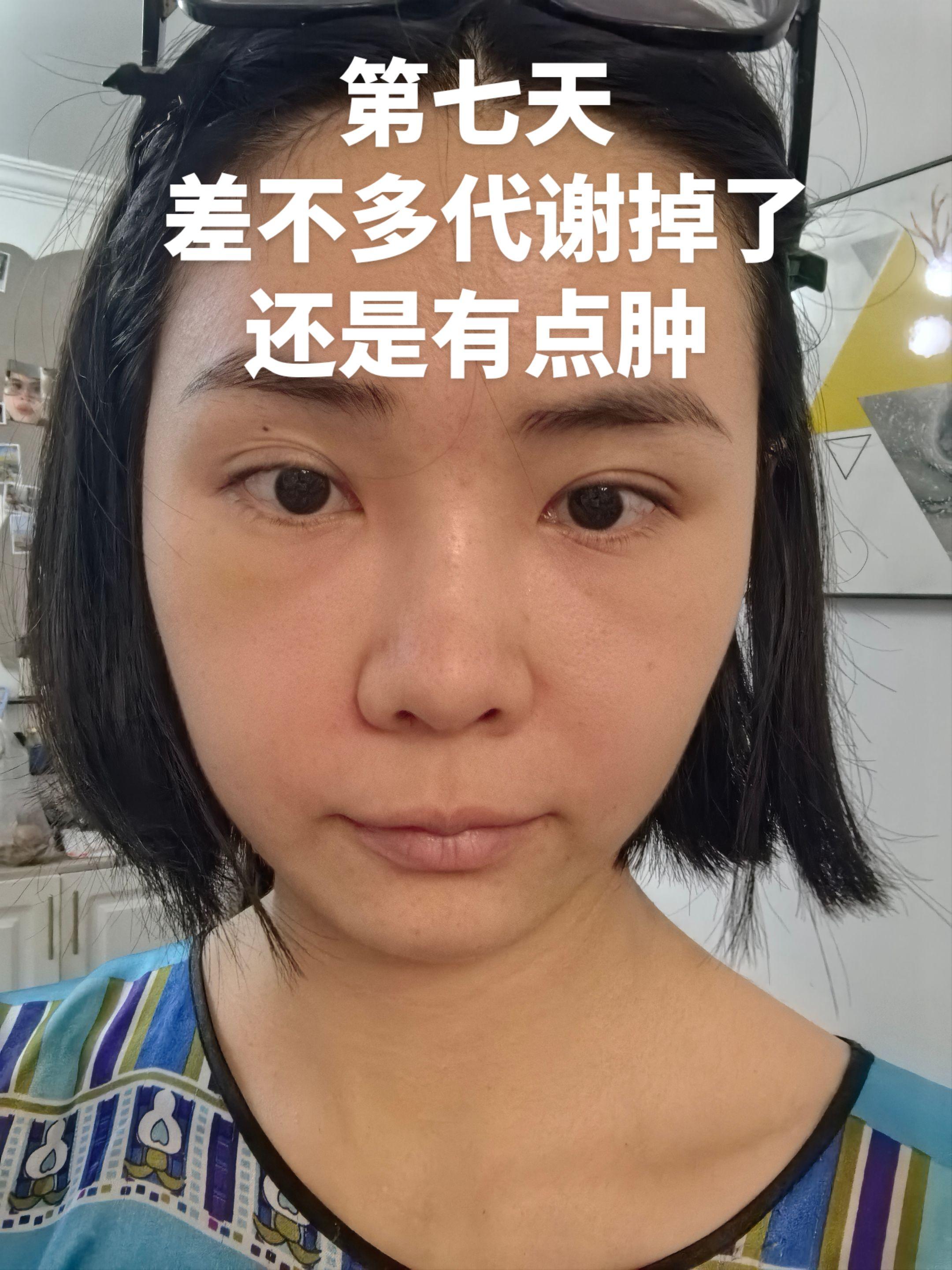 泪沟 8