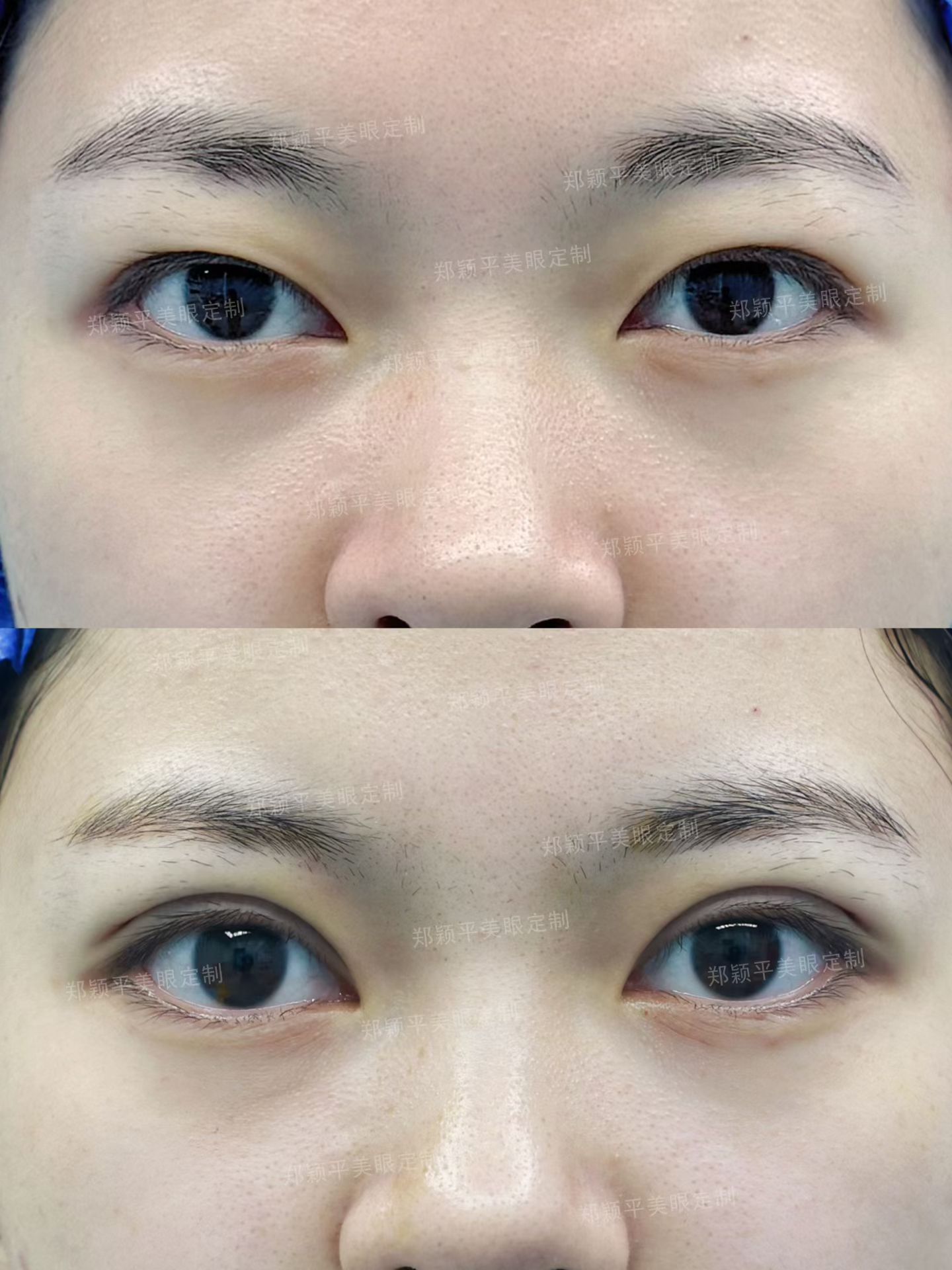 甜美柔和平行双眼皮即刻效果反馈 2