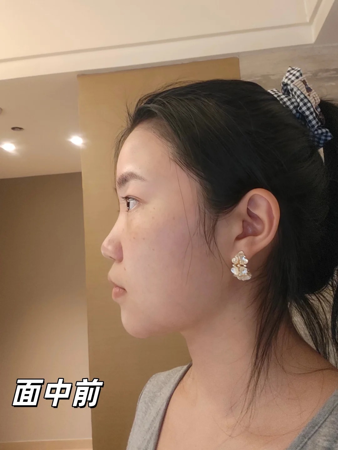拉完面中三个月 1