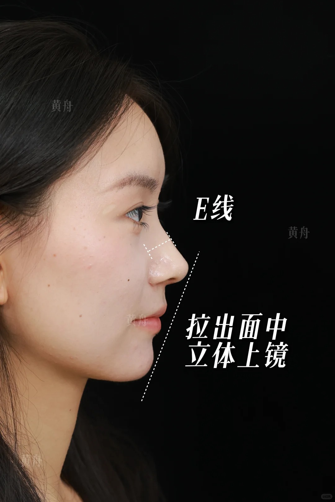 低山根妈生鼻，定制化贴合五官 2