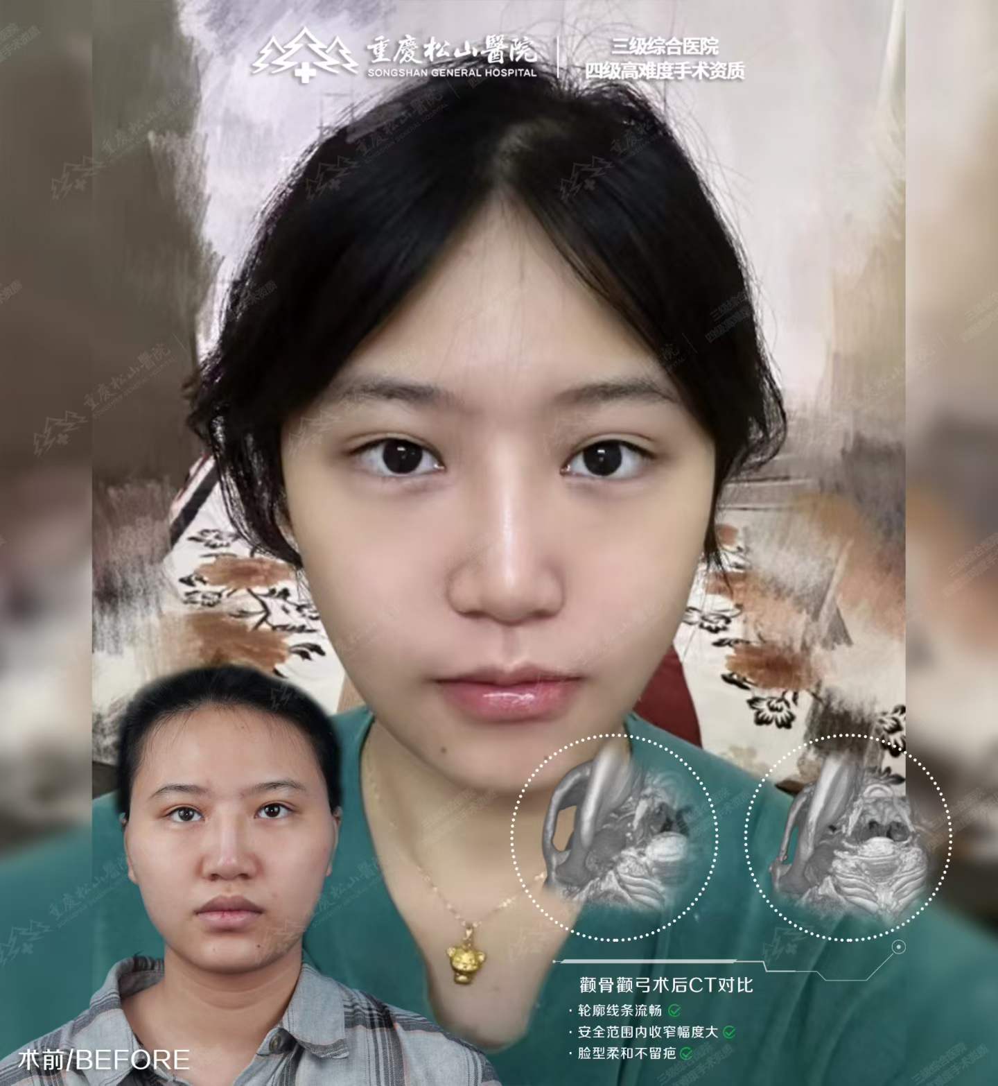 轮廓术前术后对比 1