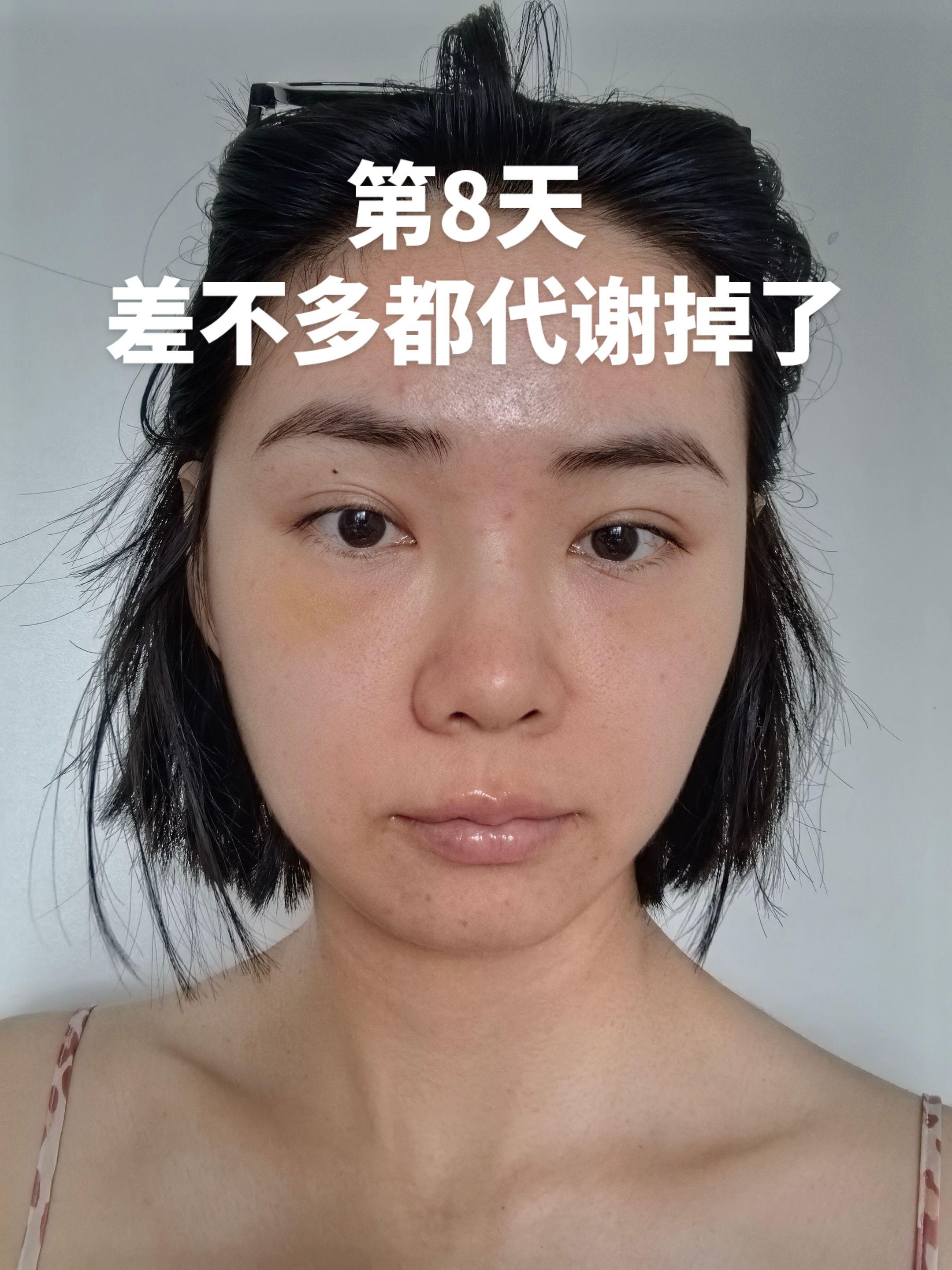 泪沟 10