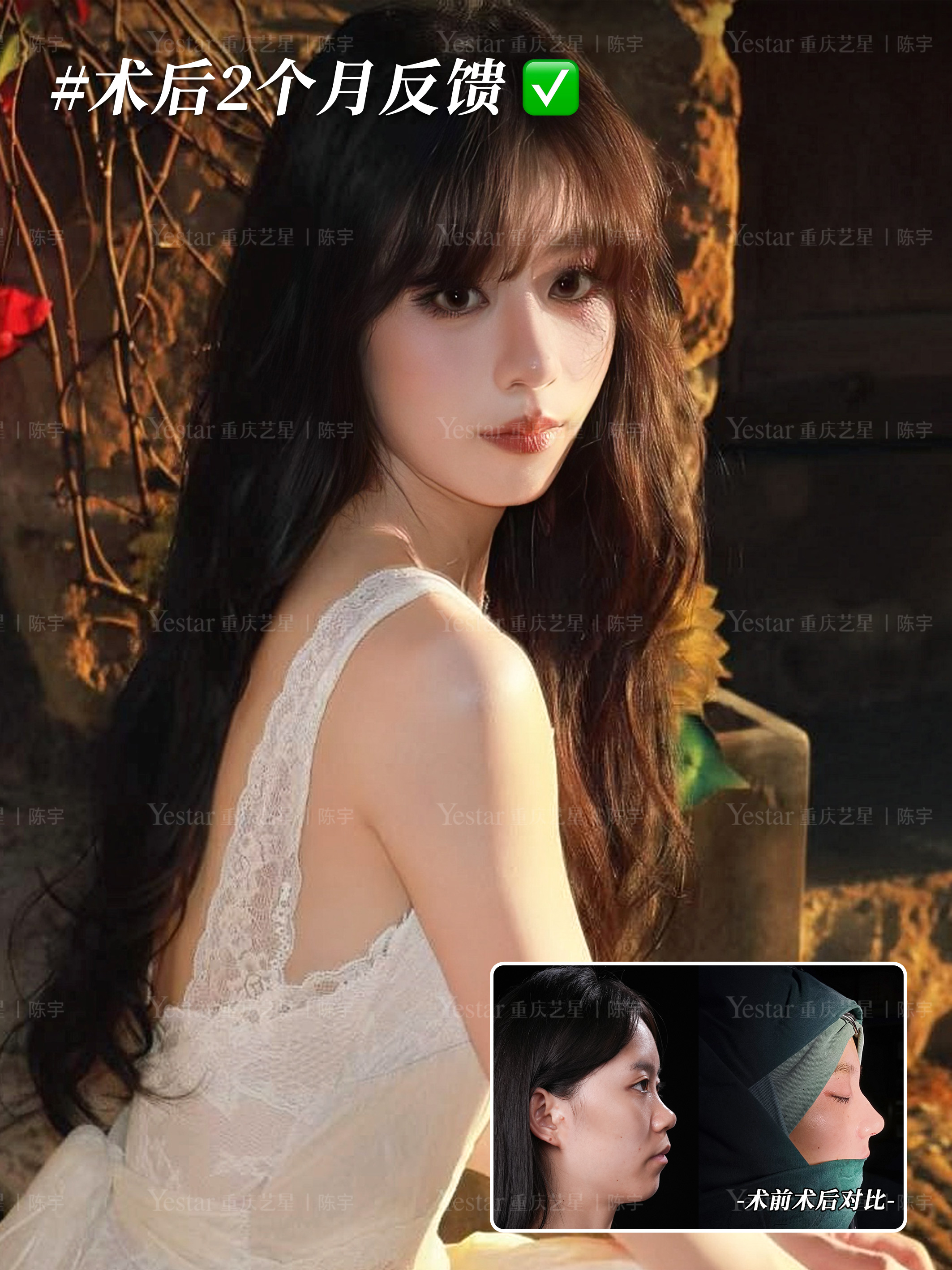 膨体肋骨鼻恢复过程记录📝 3