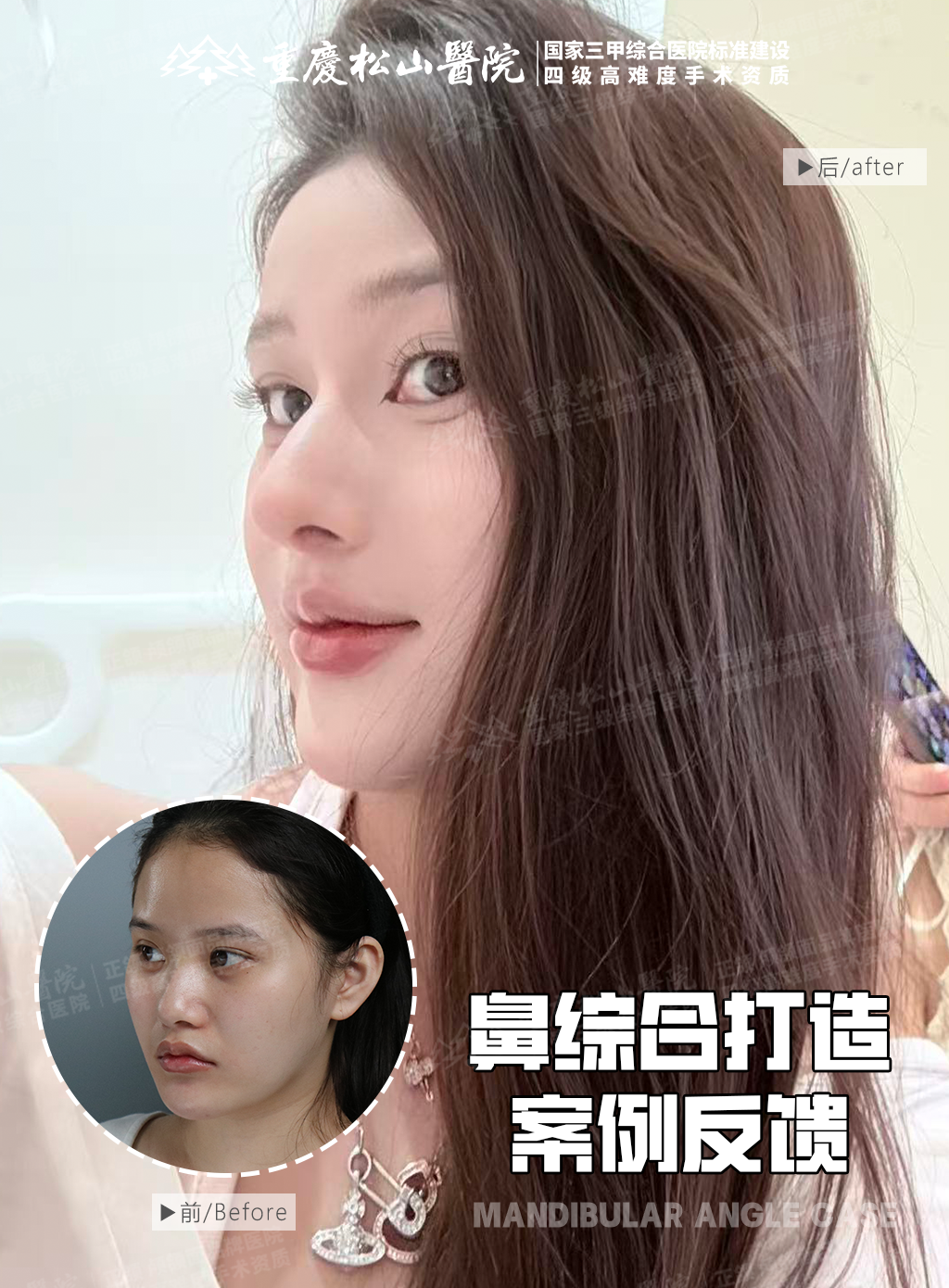 鼻综合打造 1