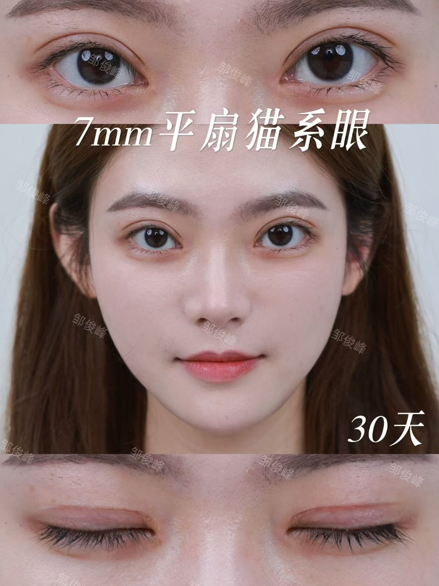 平扇术后7天拆线和术后一个月对比 2