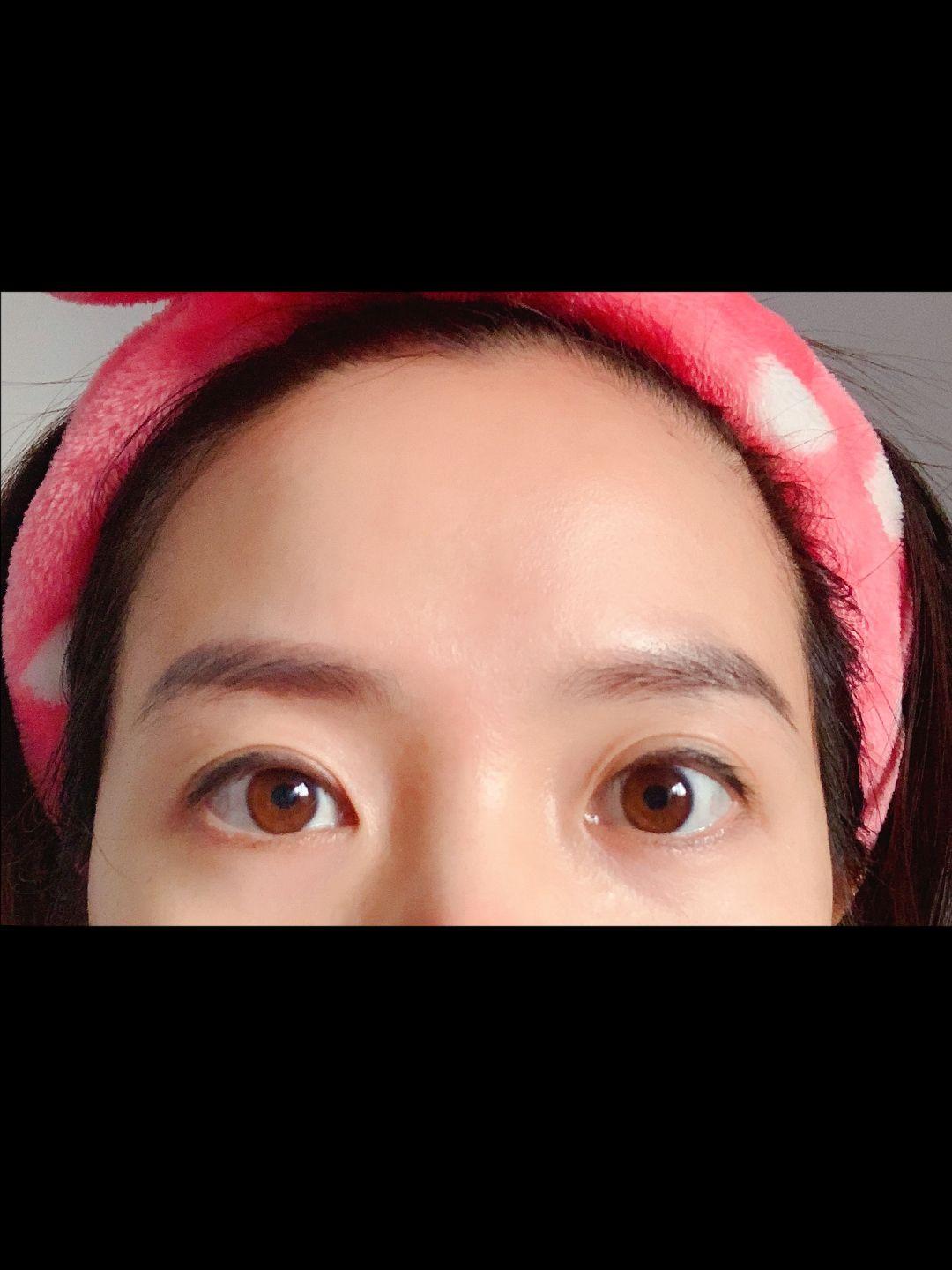 上睑下垂矫正恢复记录。 11
