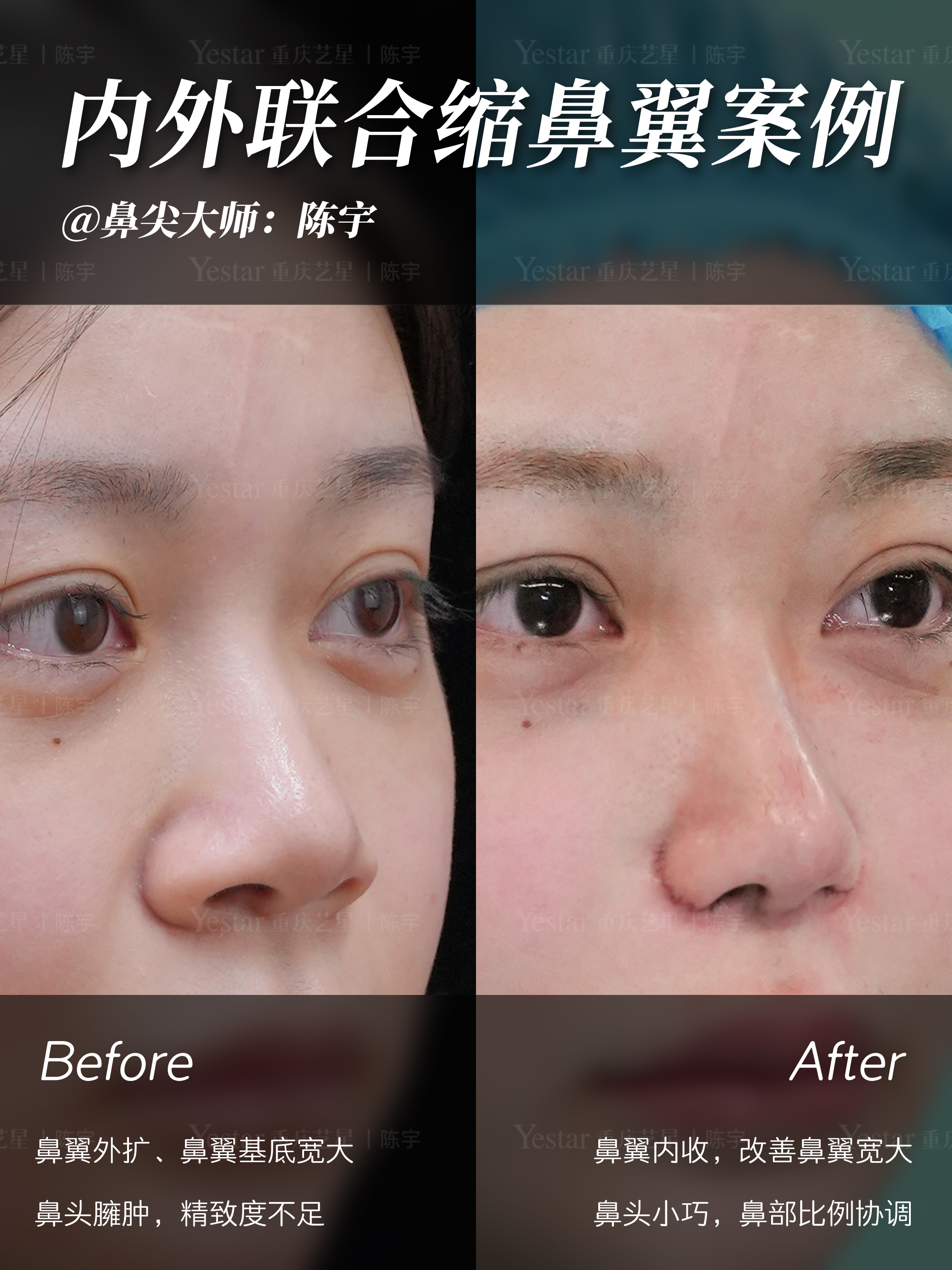 ✨内外联合缩鼻翼 2