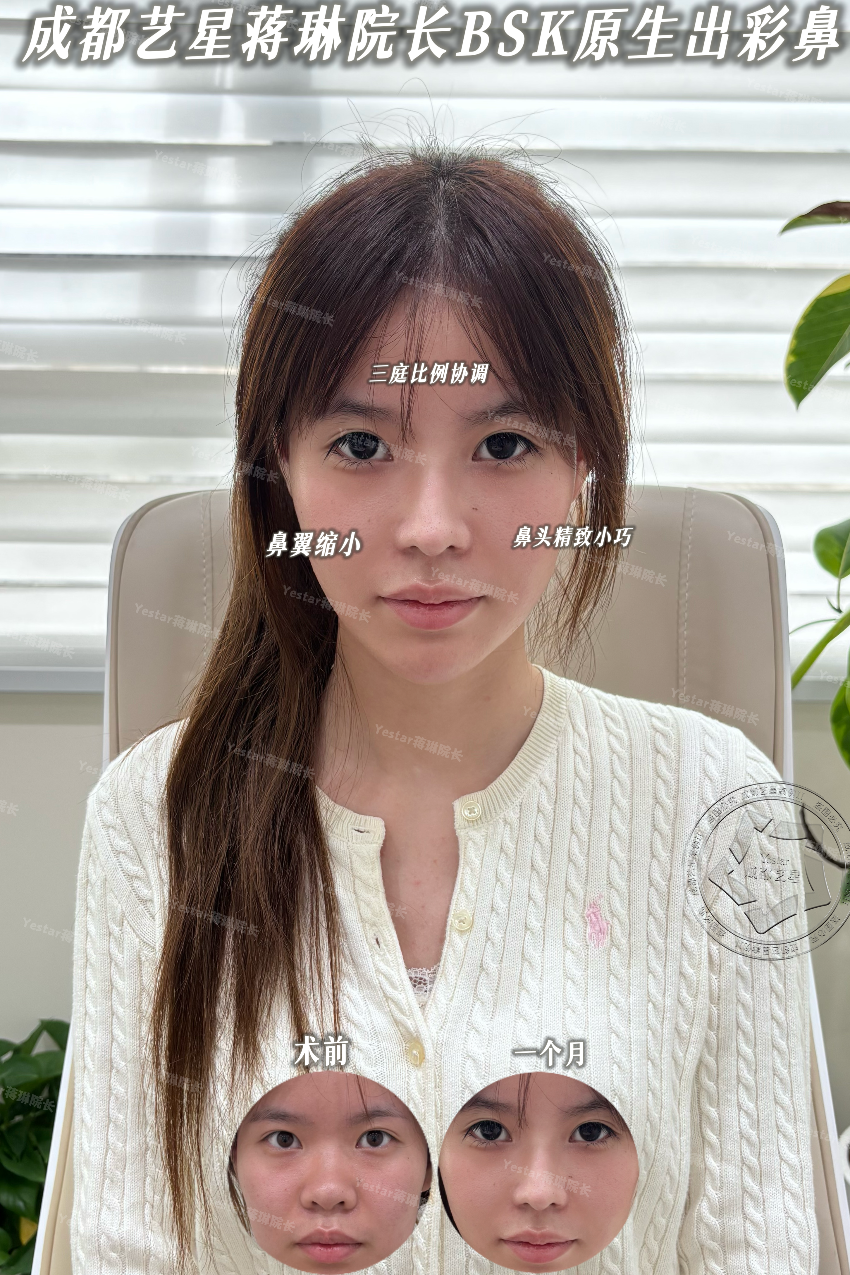 微调鼻型，协调三庭 2
