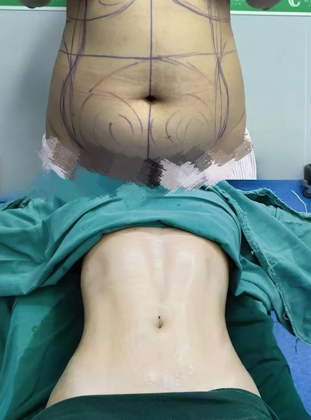✨腰腹精雕修复