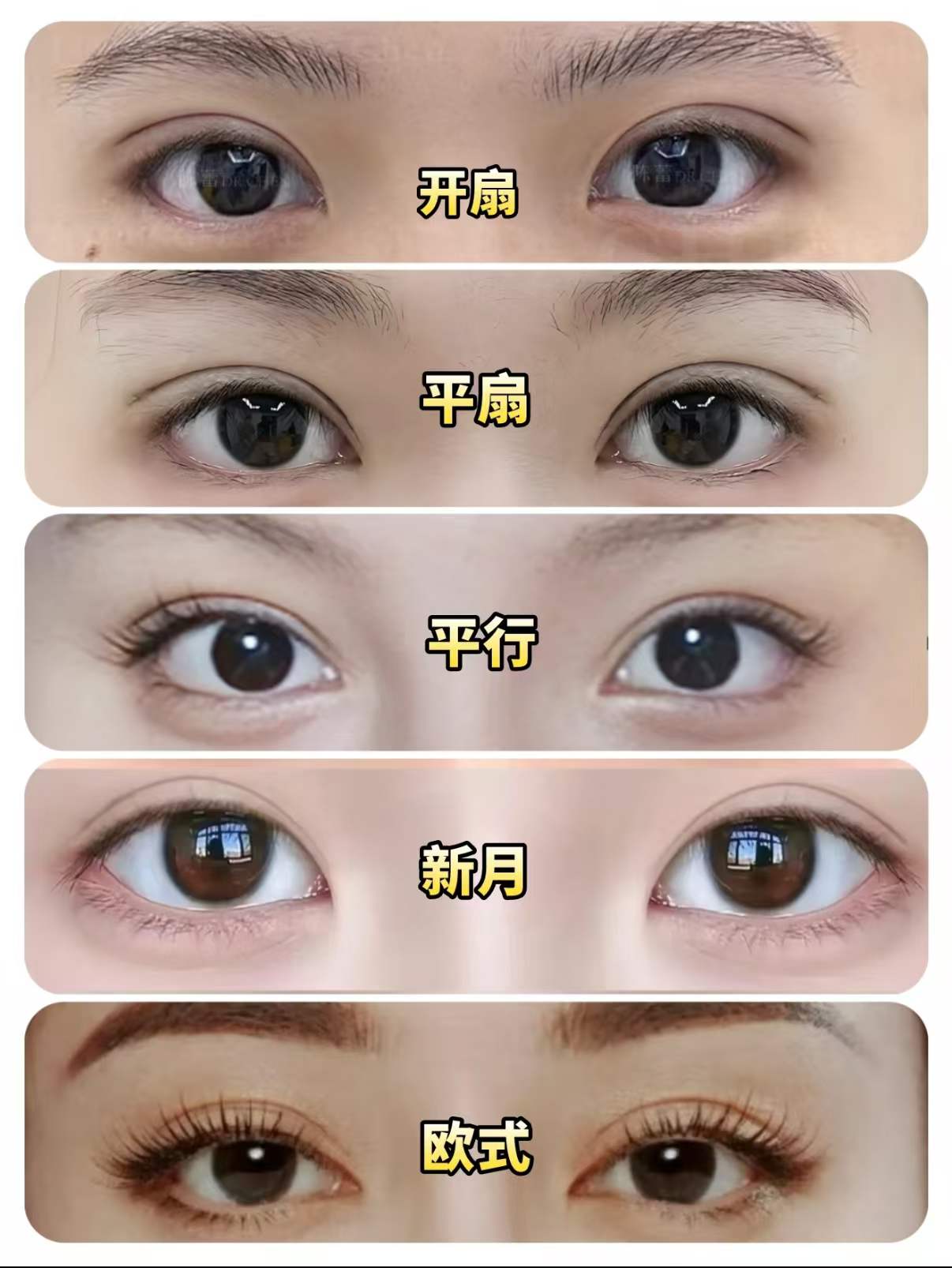 纠结双眼皮形态的姐妹可以看看参考 1