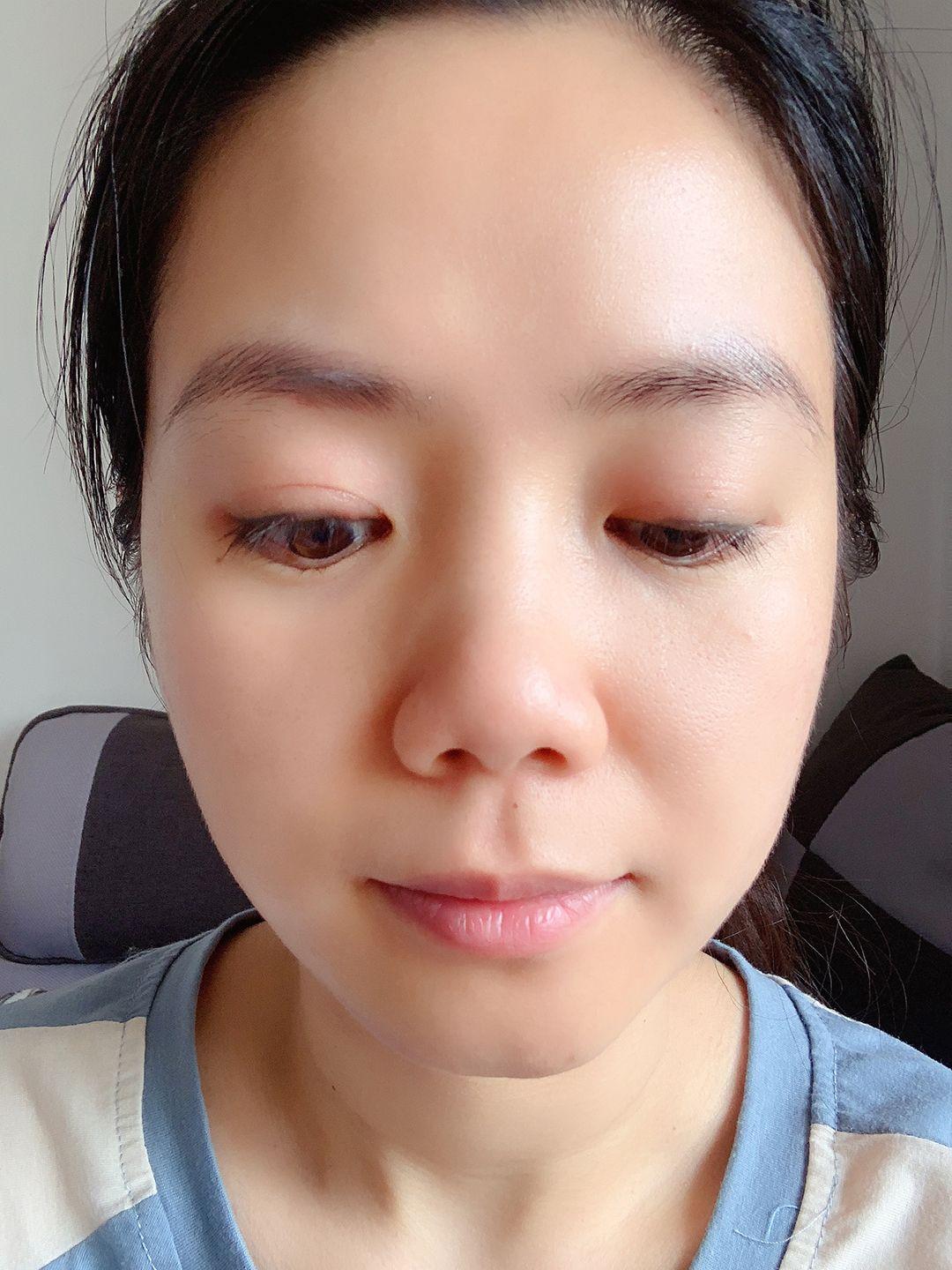 上睑下垂矫正恢复记录。 10