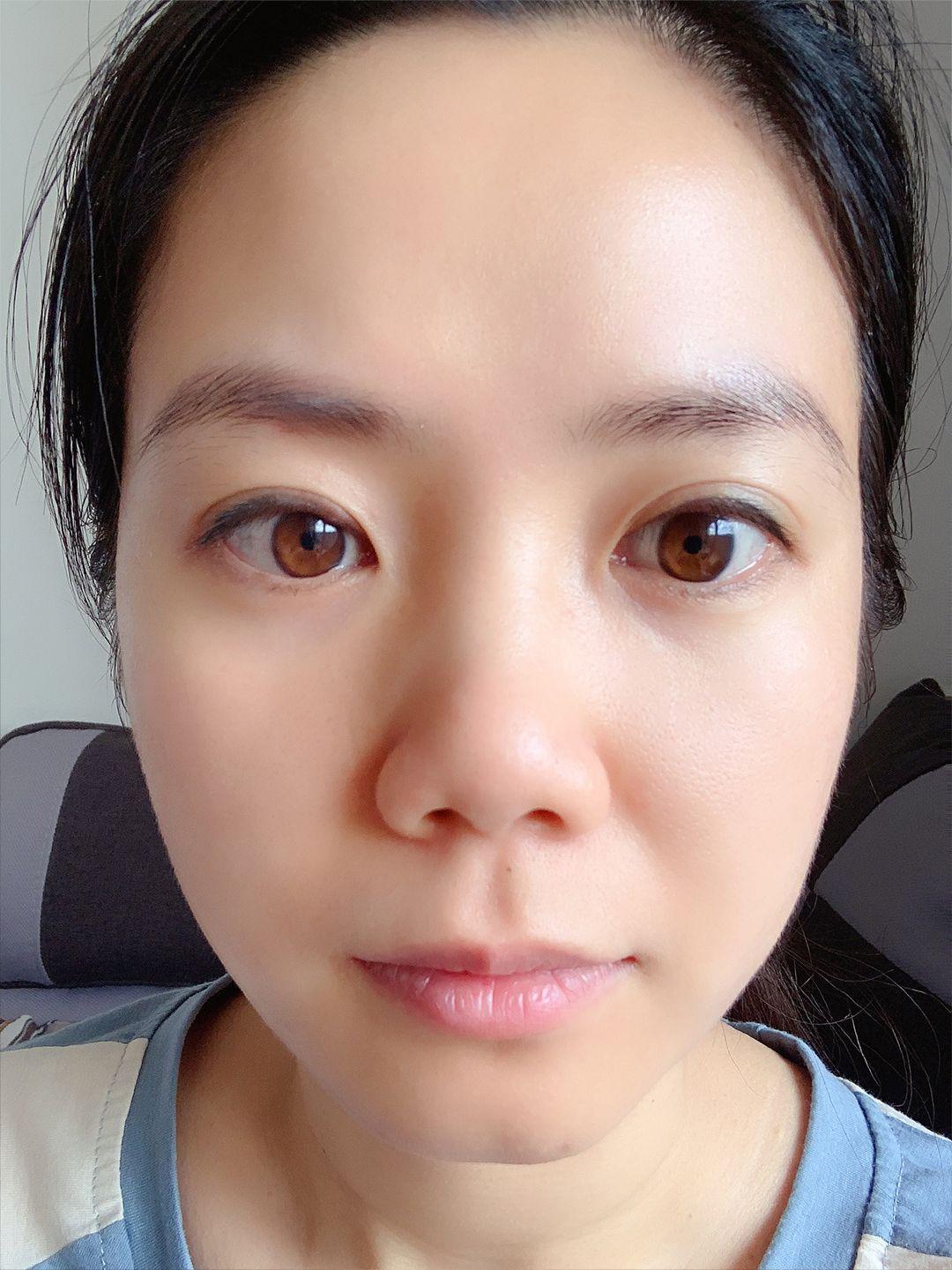 上睑下垂矫正恢复记录。 9