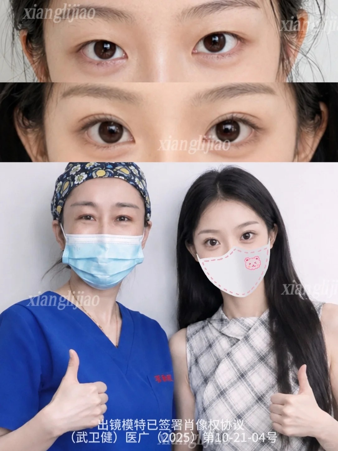 武汉双眼皮丨7mm平扇 小野猫即视感～ 2