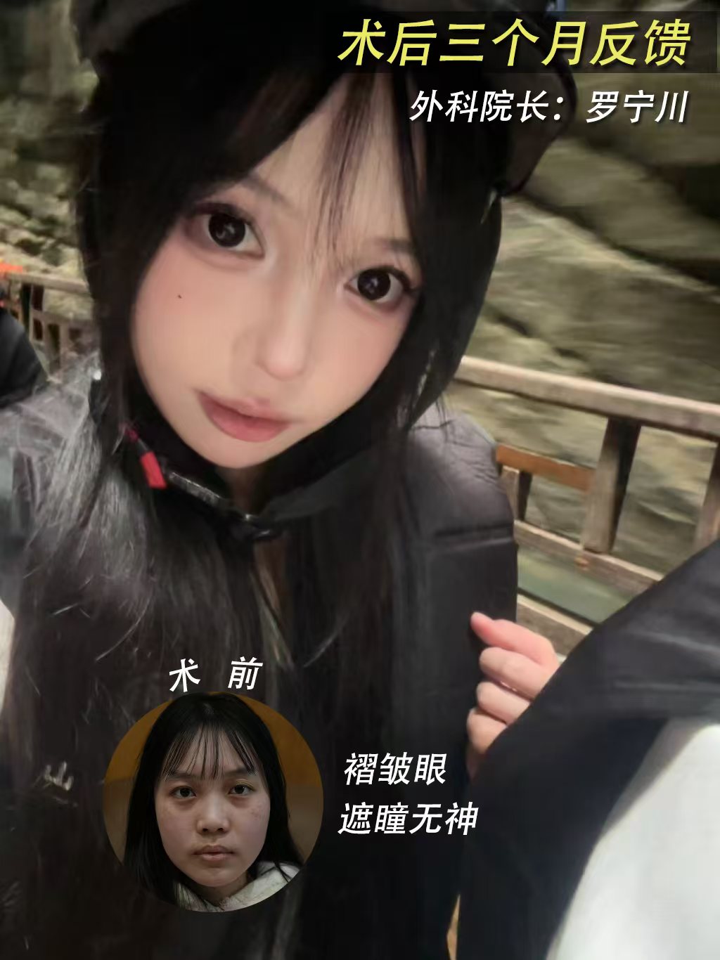 双眼皮打造案例🌿术后三个月真实反馈 1