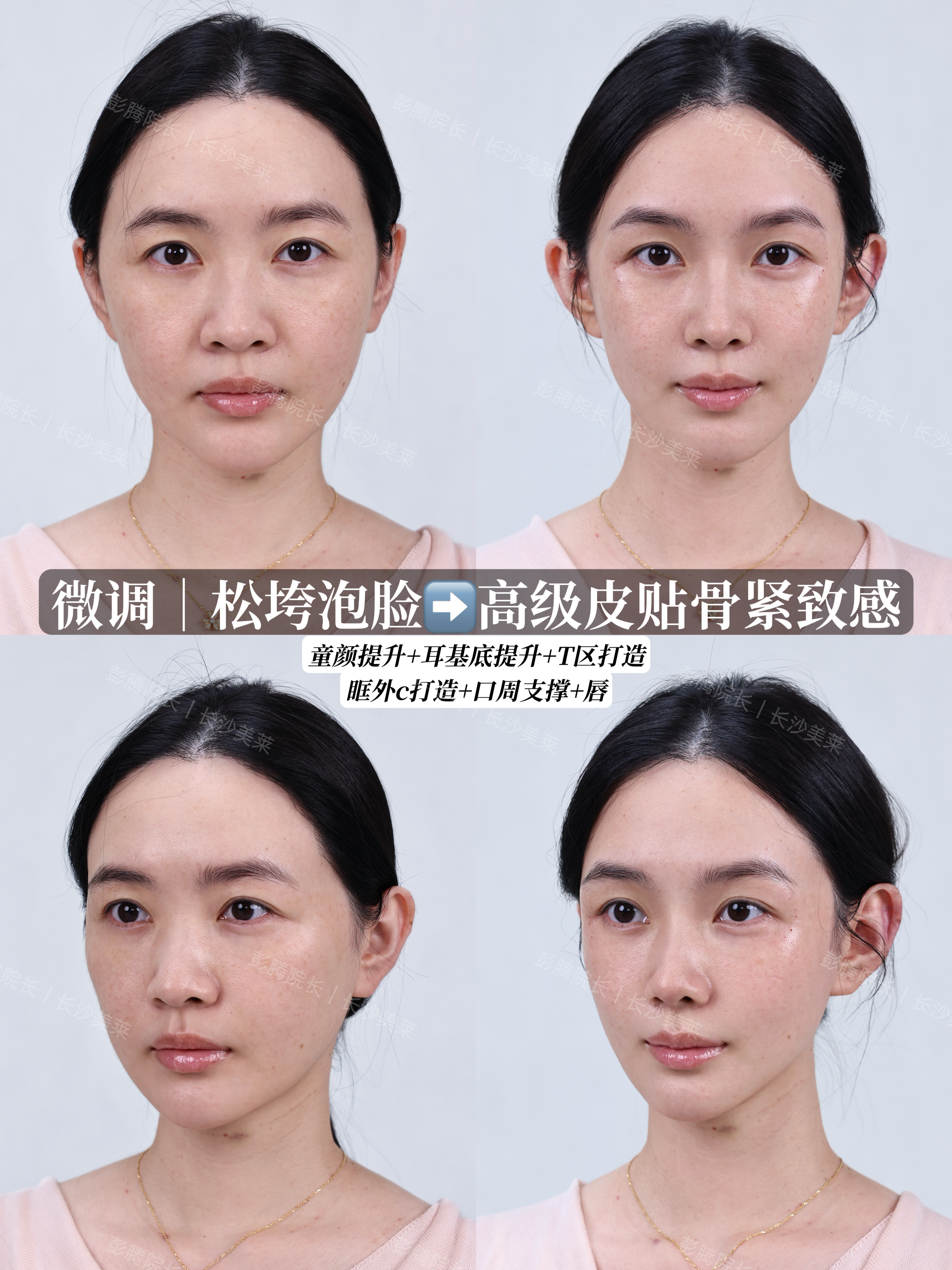 彭腾院长案例分享 1