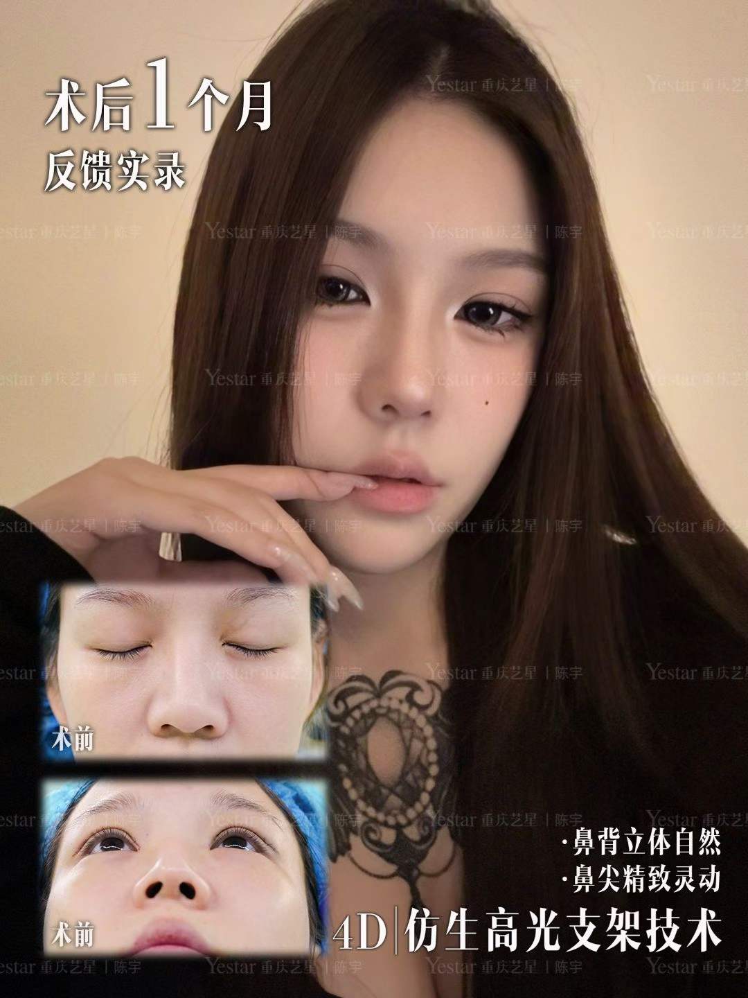 4D仿生高光支架技术 1