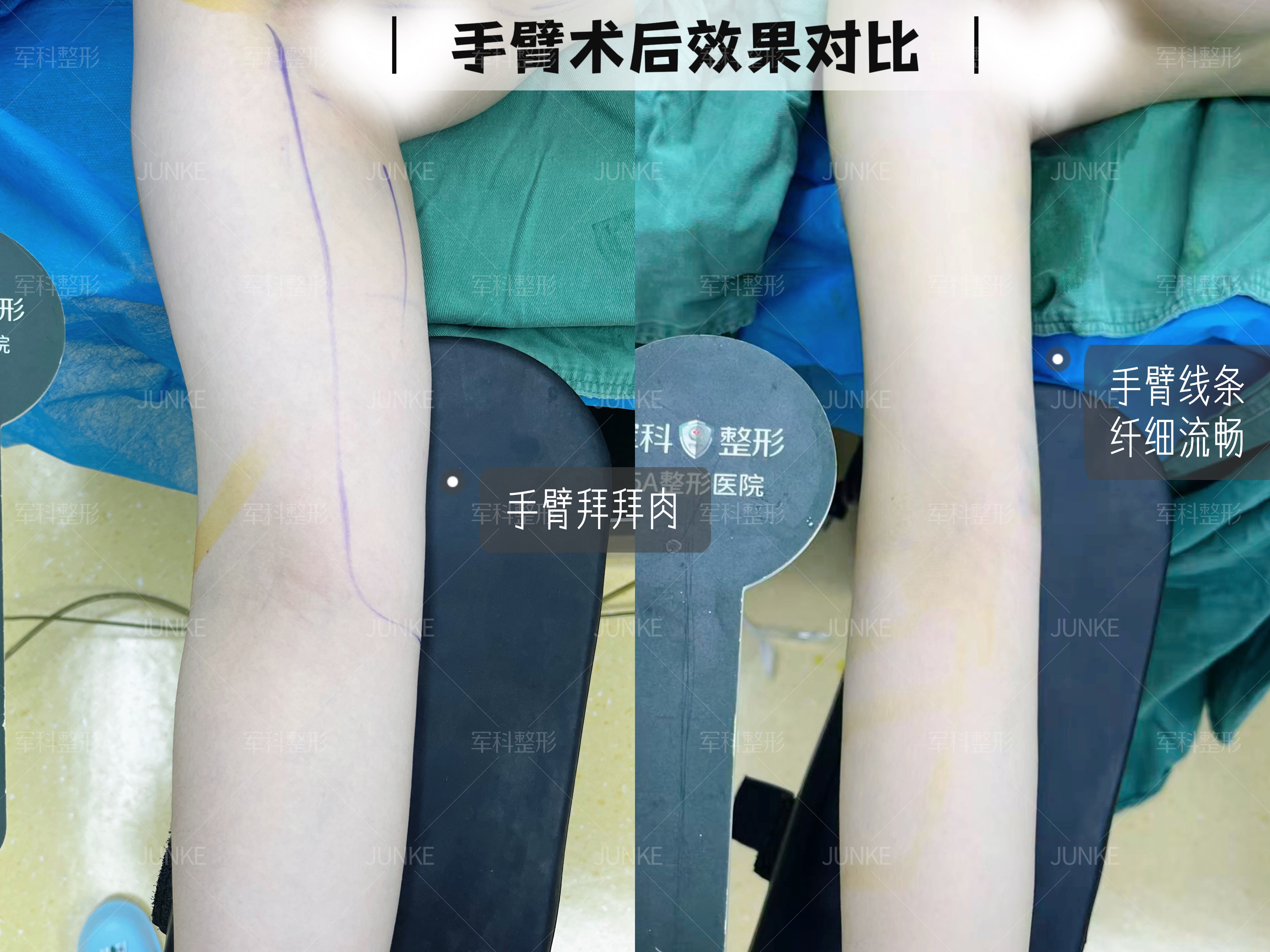手臂吸脂术后实拍📸 1