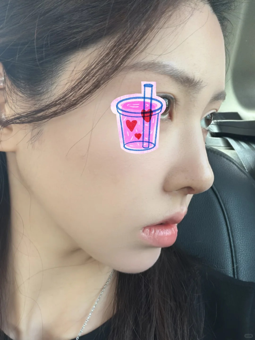术后效果不错呢 2