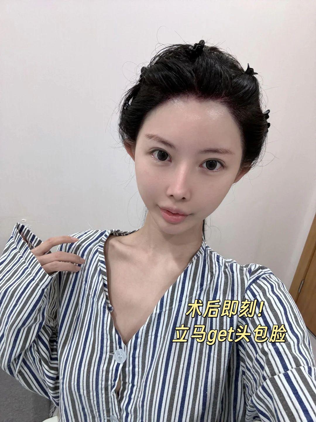 不剃发植发 植发手术 8