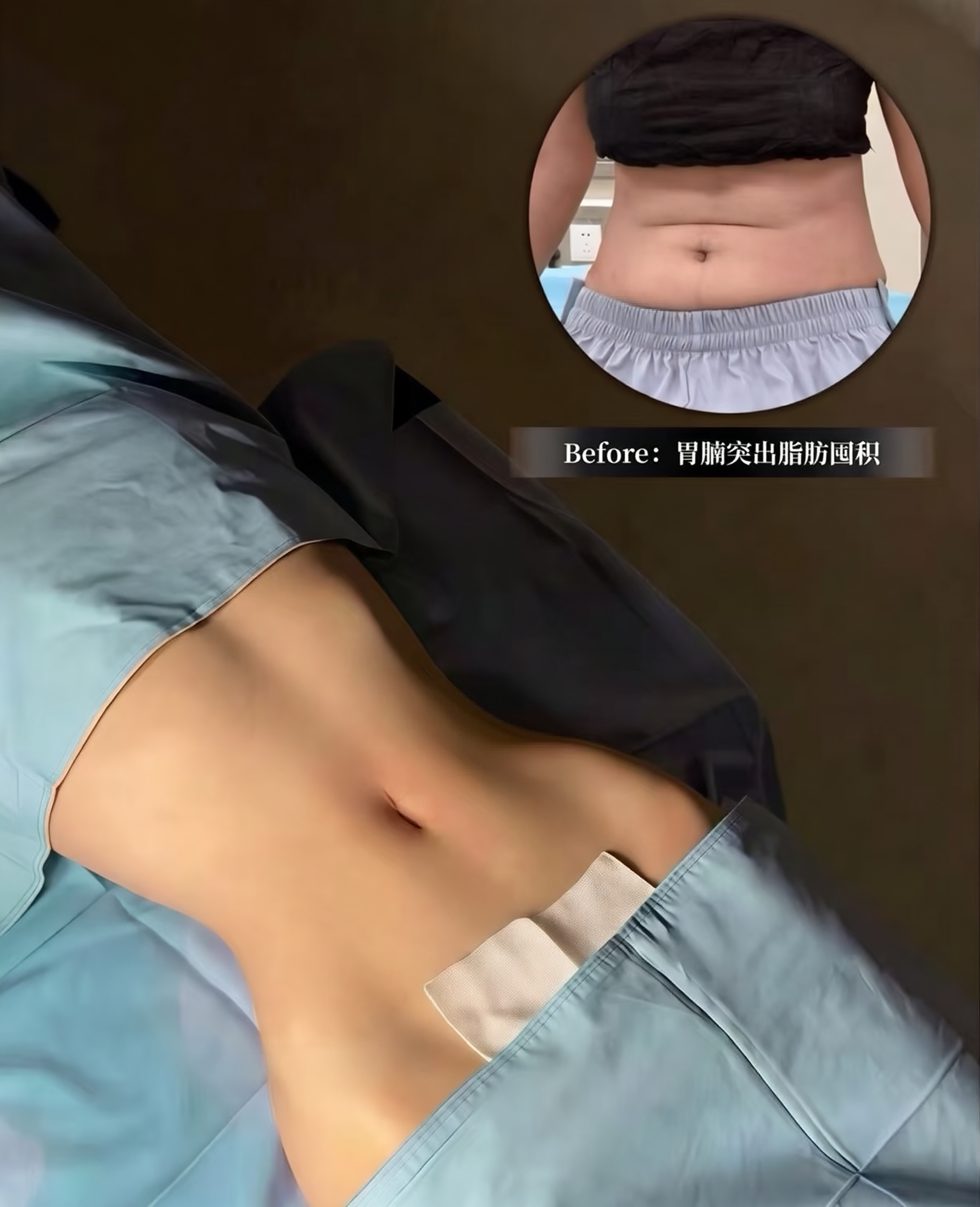 腰腹赘肉堆积？ 1