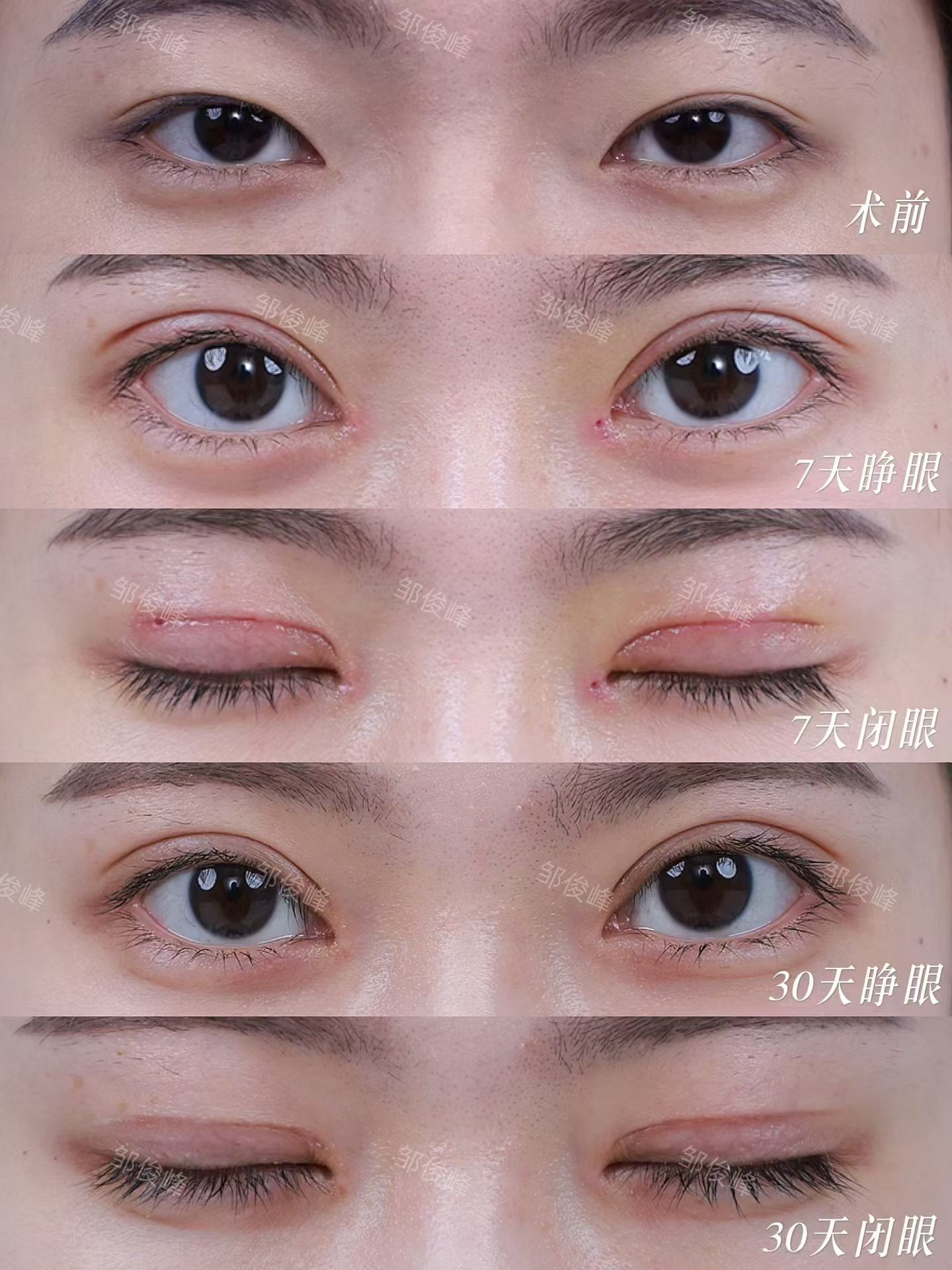 平扇术后7天拆线和术后一个月对比 3