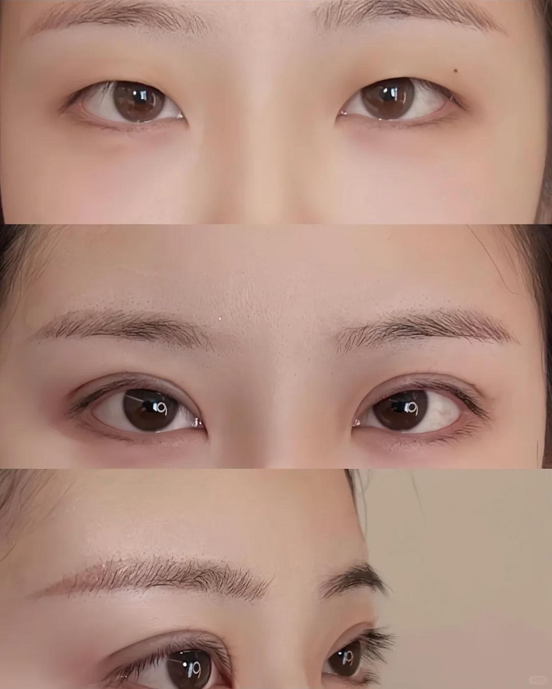 贵阳双眼皮