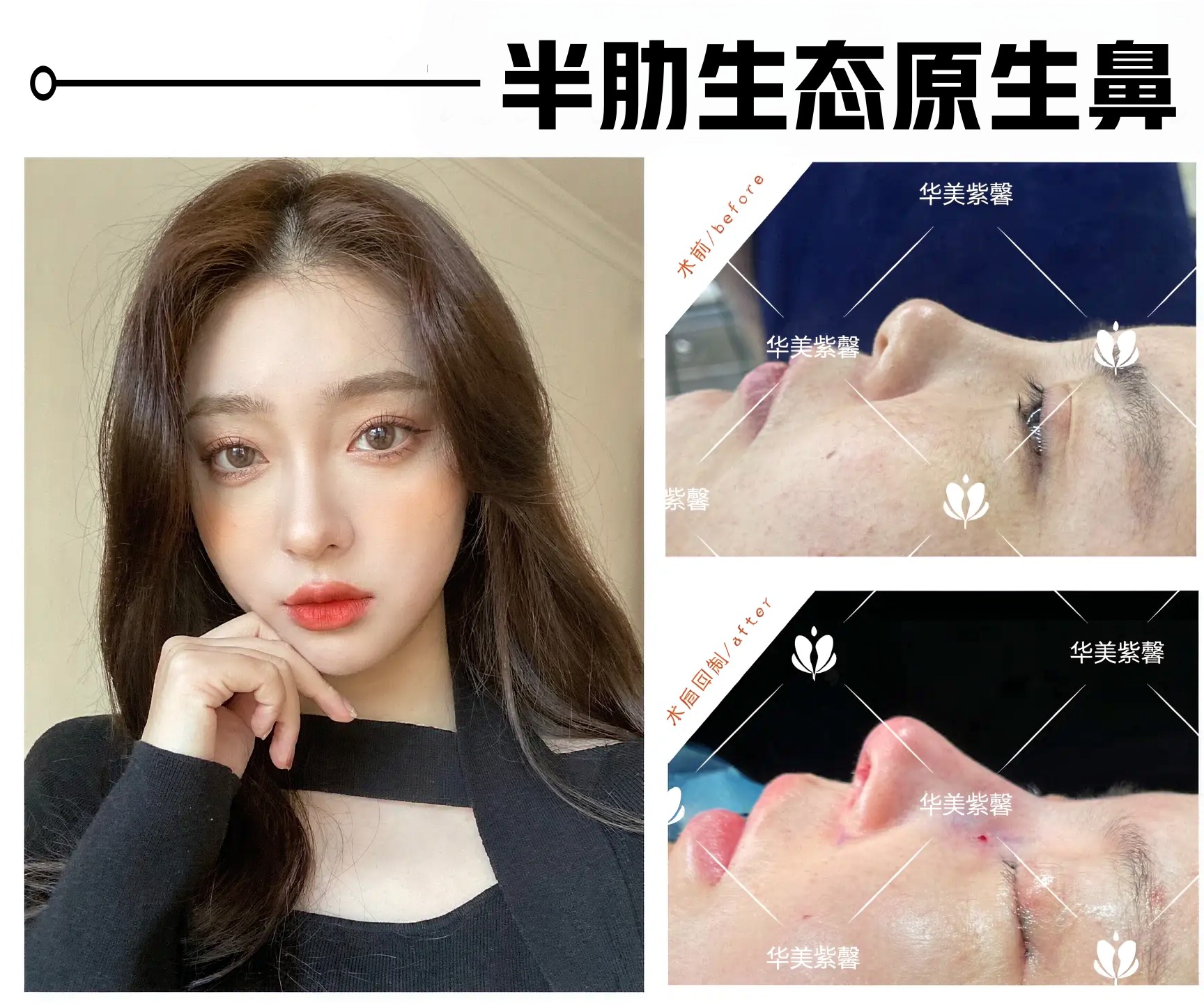 汪志强院长鼻综合案例分享 1