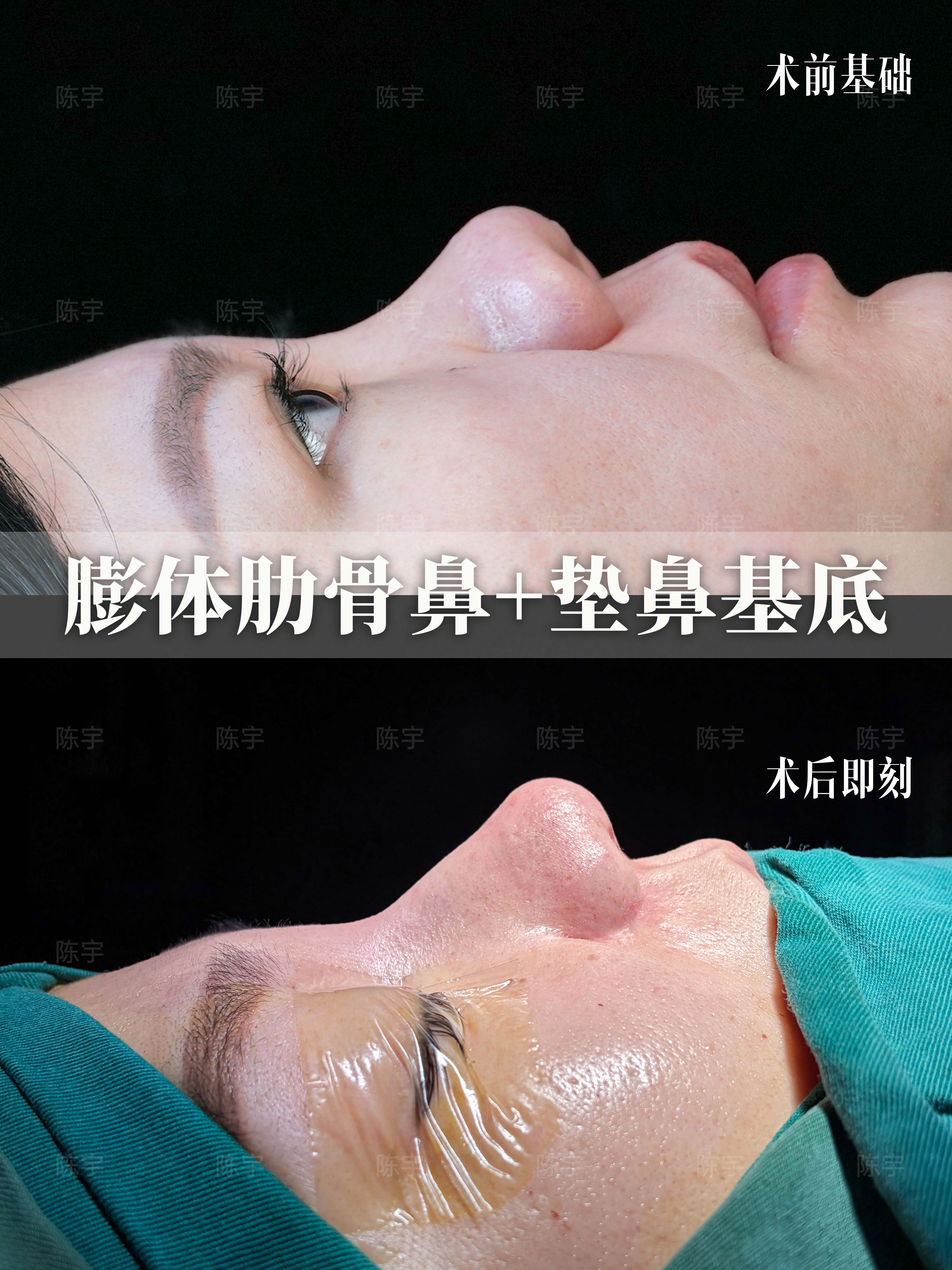 蒜头鼻 鼻综合改善👃 1