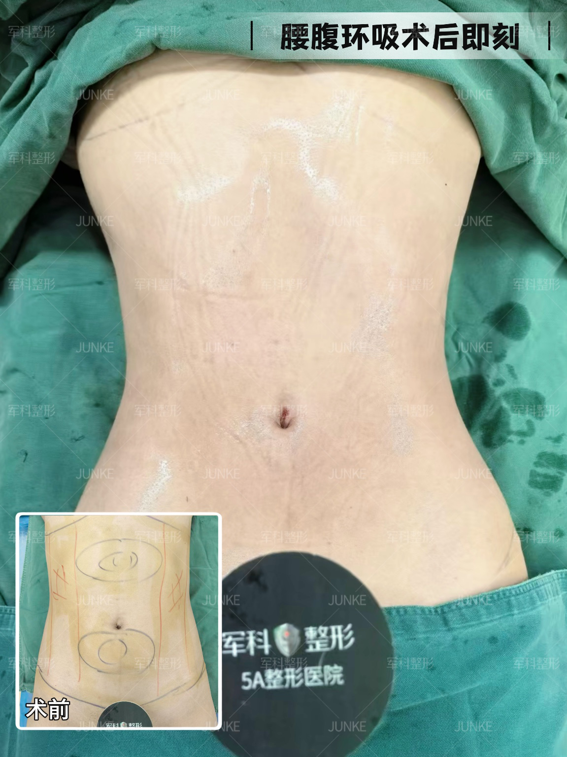 腰腹术后即刻效果✨ 1