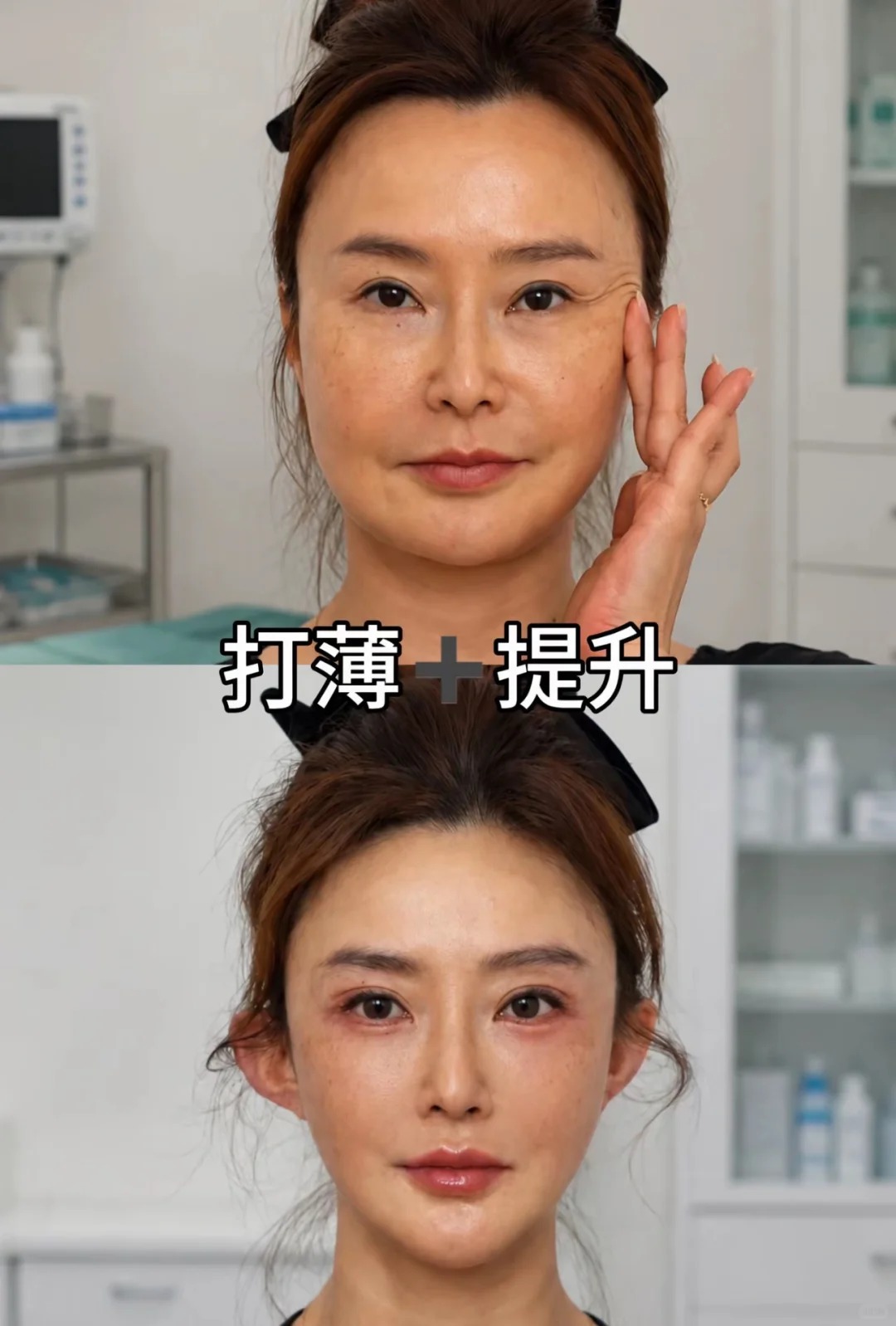40+姐姐面部打薄+提升
