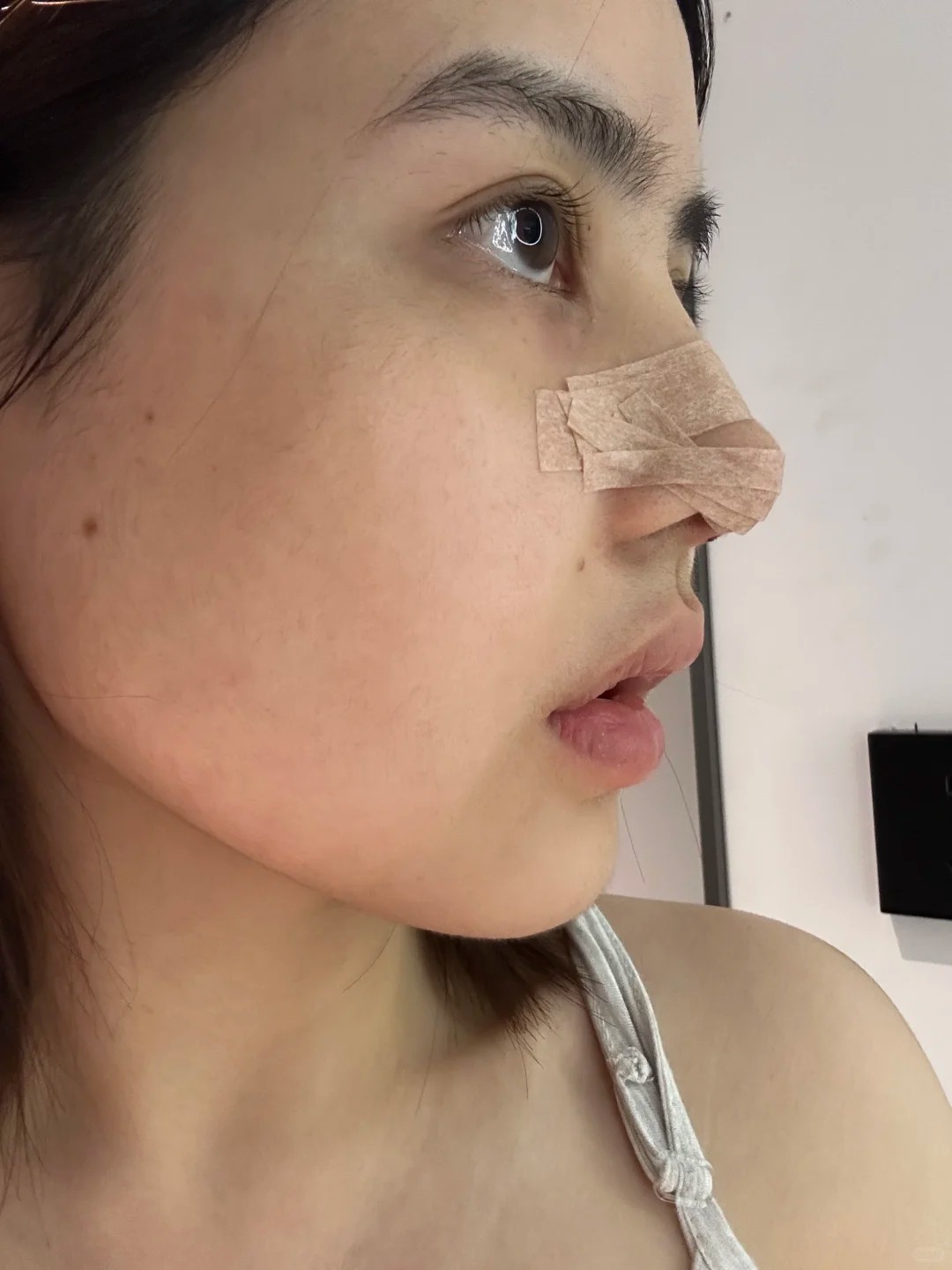 静待新鼻慢慢消肿✨ 1