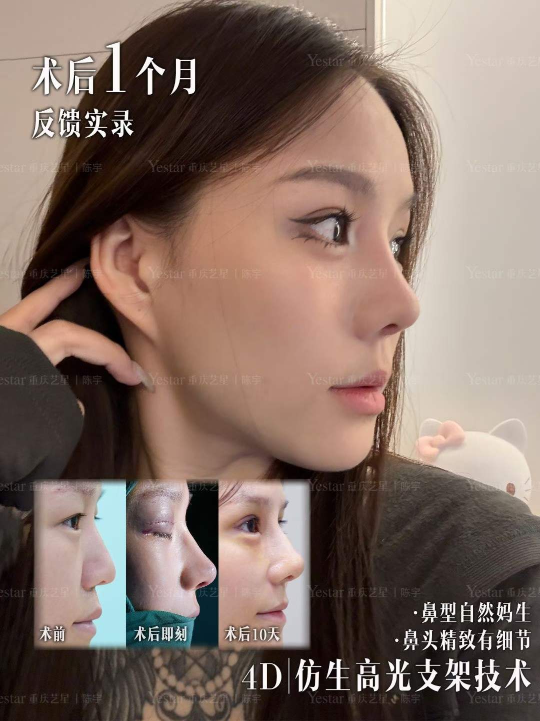 术后1个月反馈实录 1