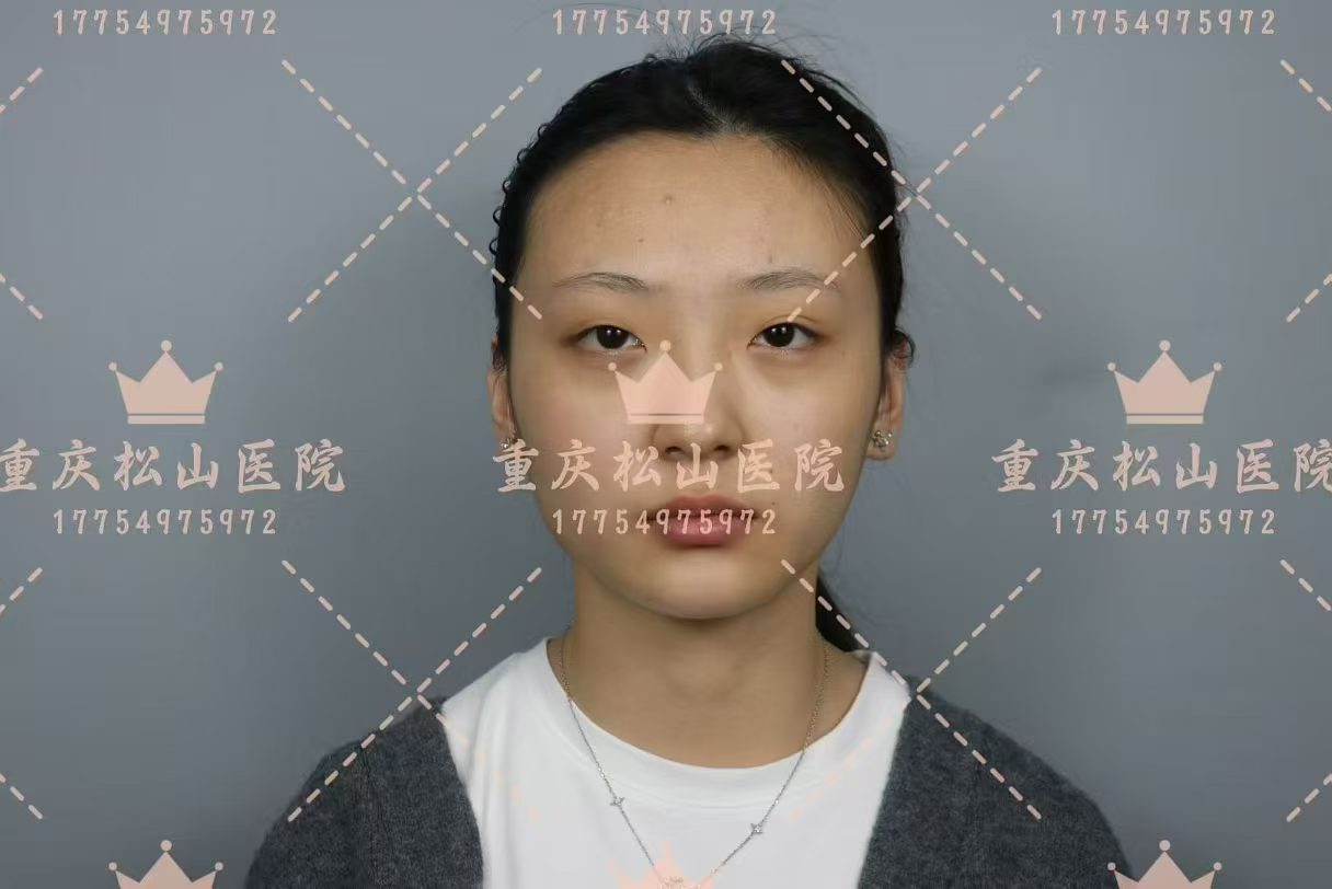 轮廓术后带来的自信具象化啦 2