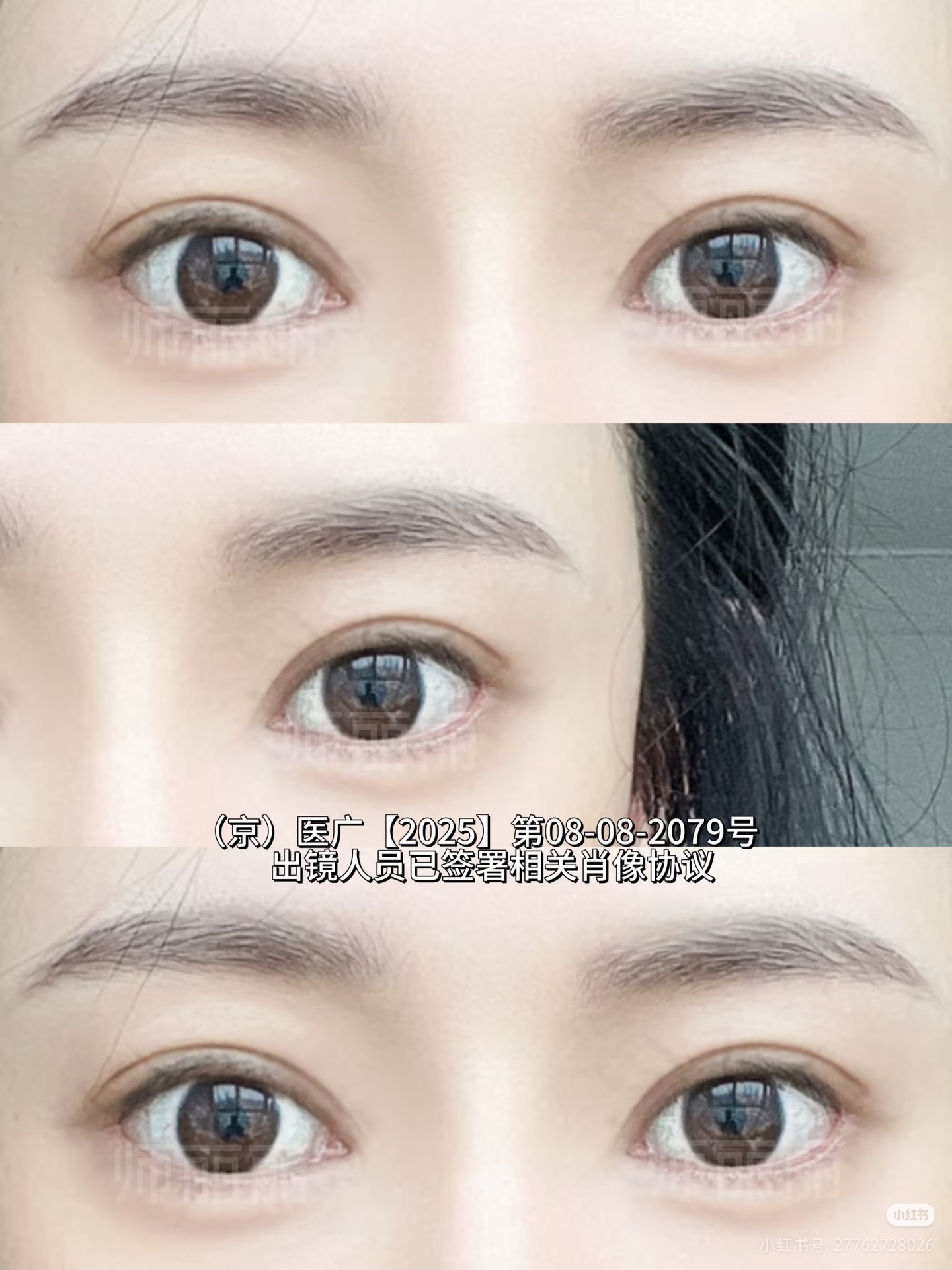 北京眼修复｜6mm小鹿眼+眼角回包，幼态