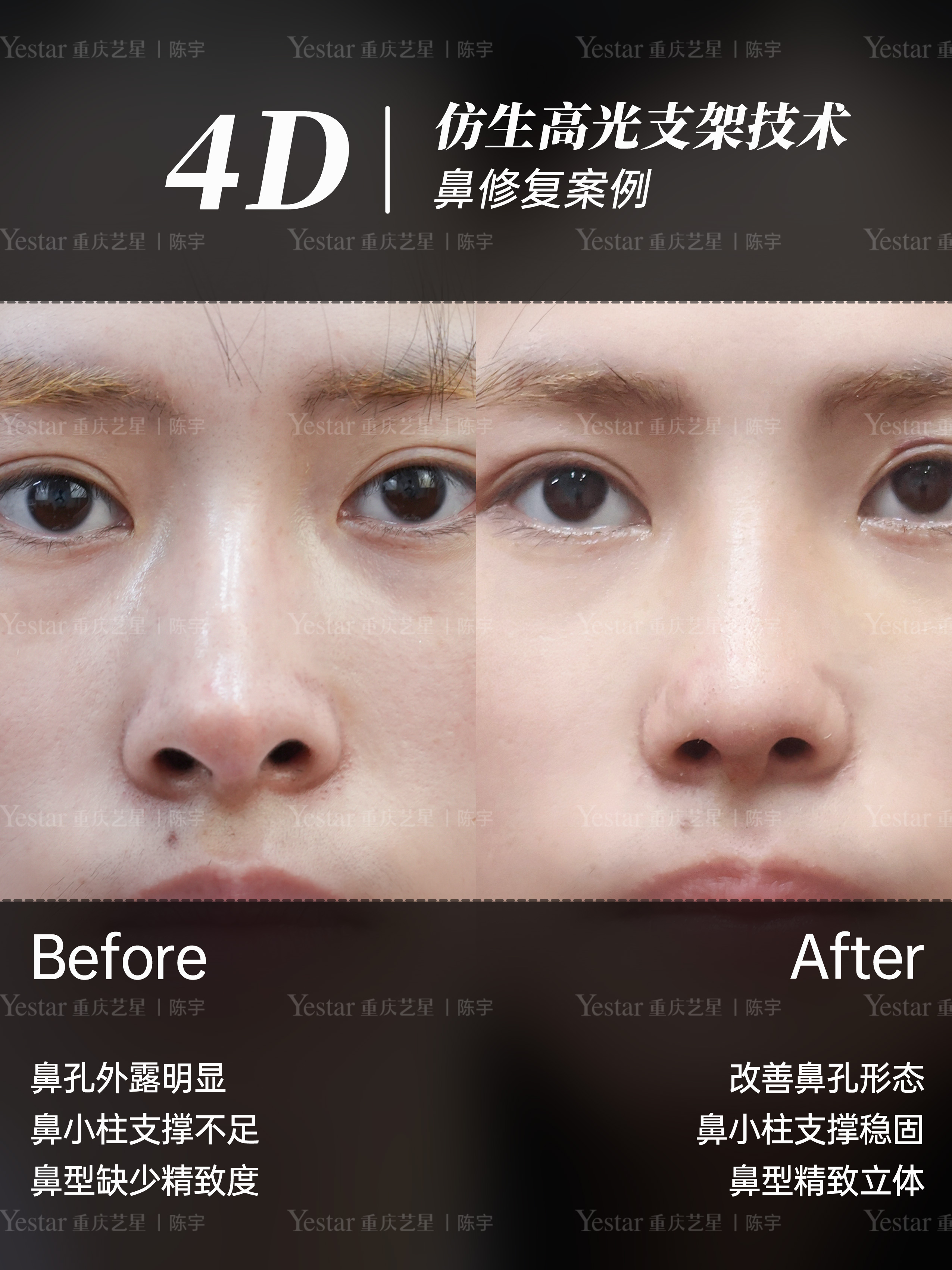 膨体肋骨鼻修复👃 3