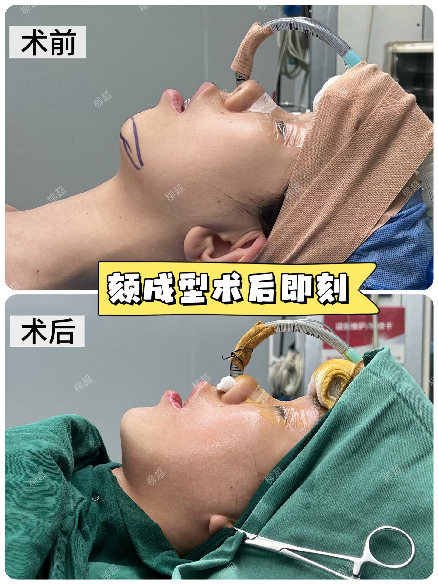 颏成型术后即刻💫 1