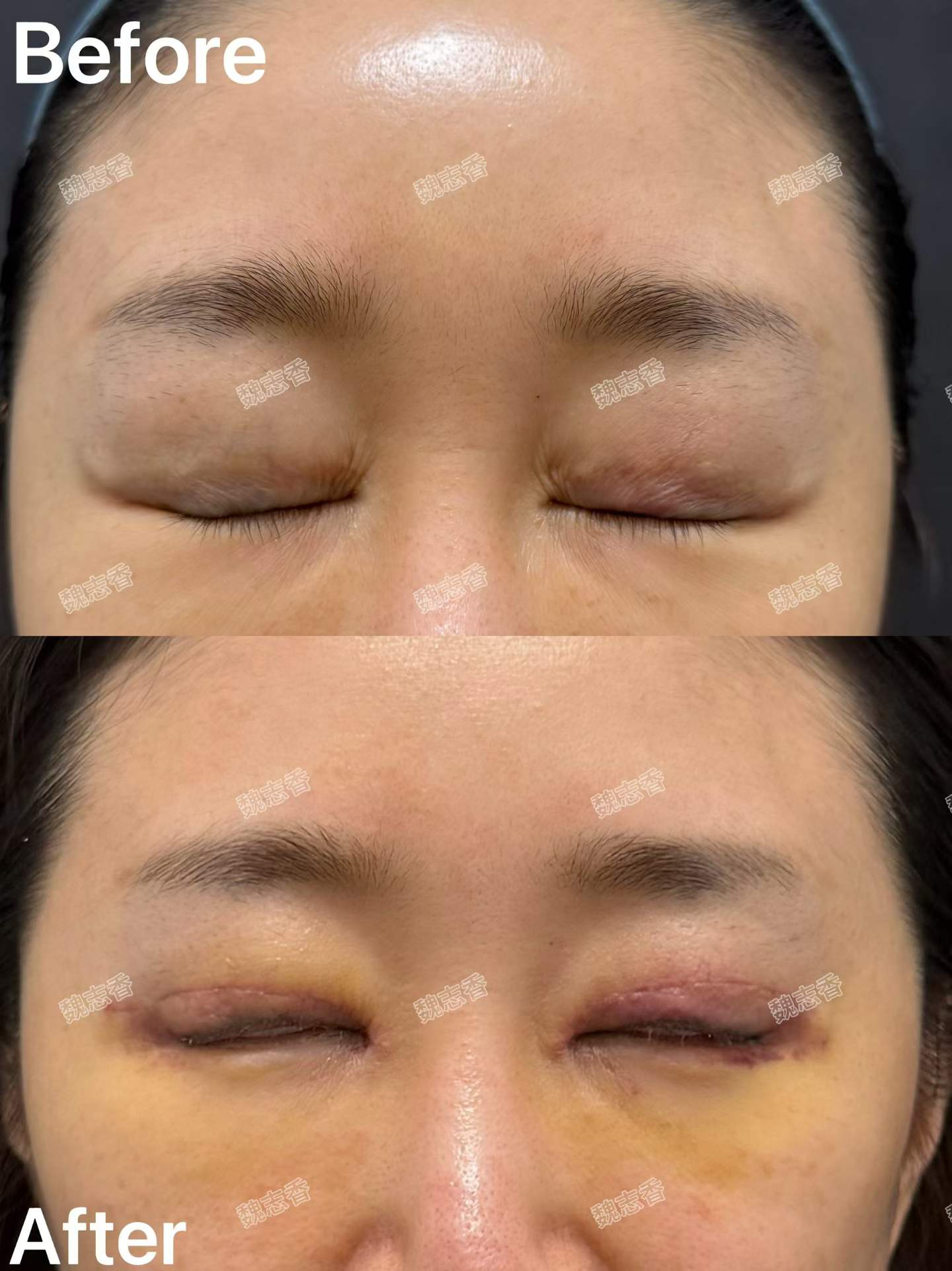 双眼皮修复➕内眼角修复术后七天 2