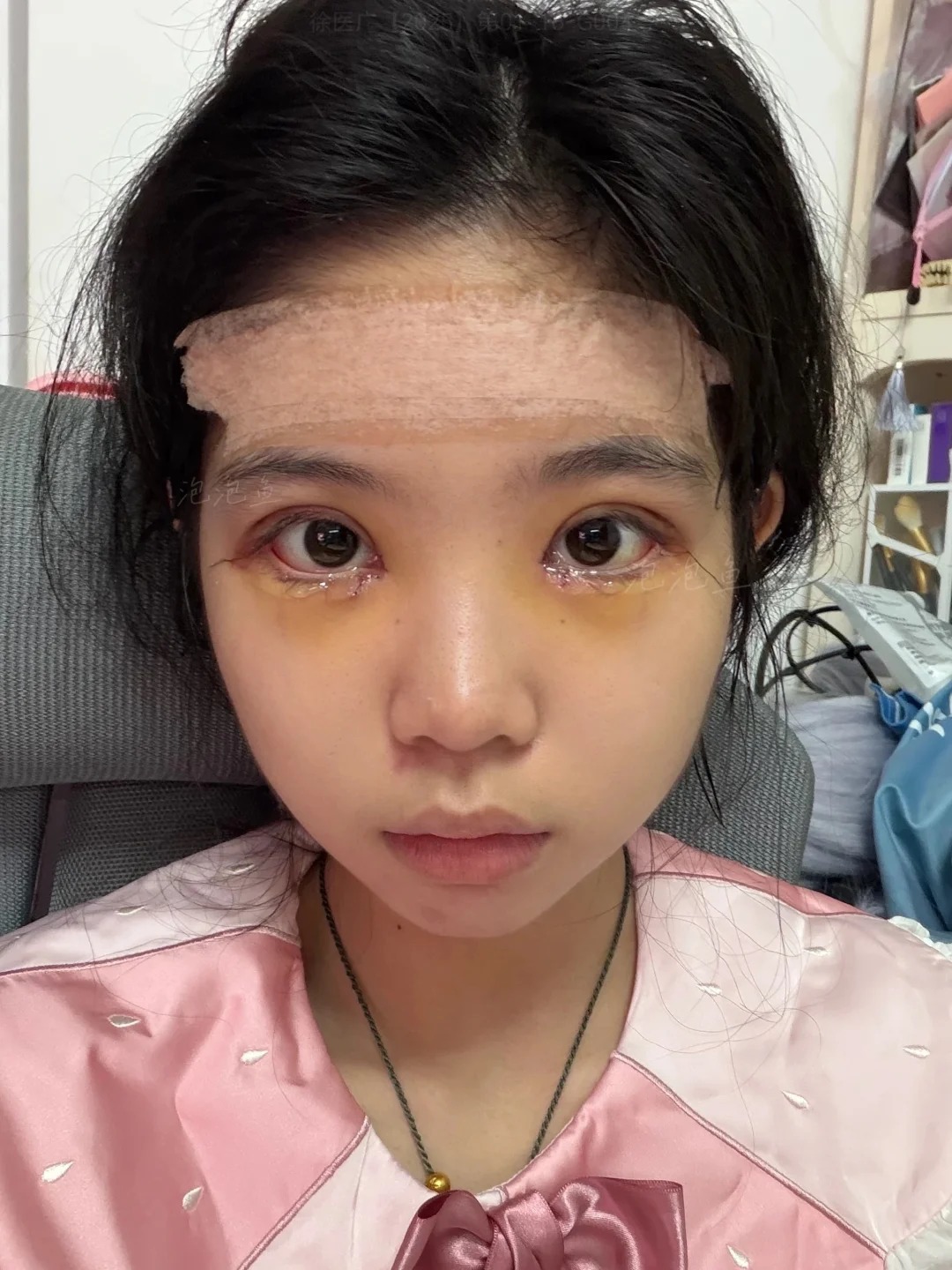 噶双眼皮大成功！！ 3