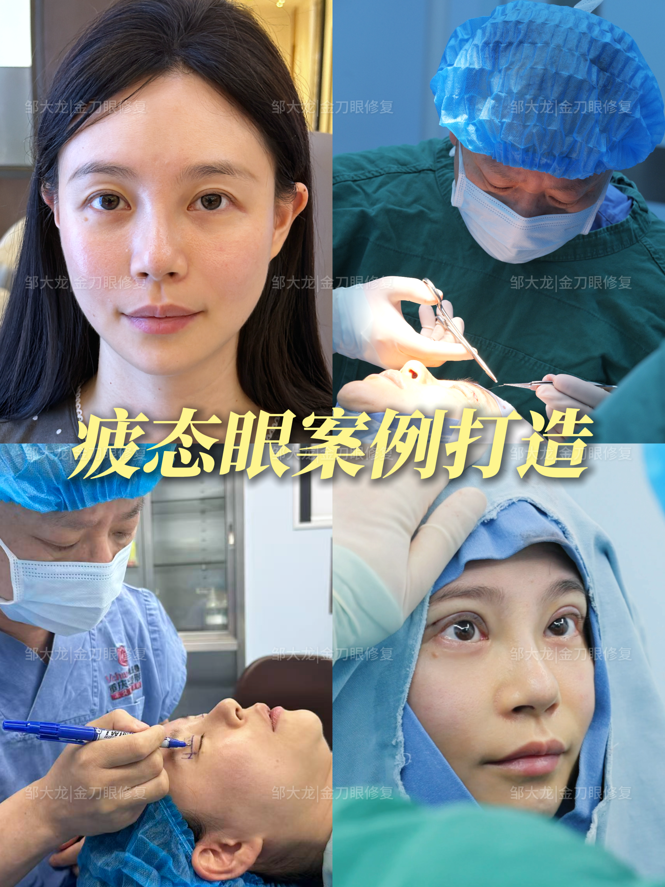 阿尔法定制美眼 3
