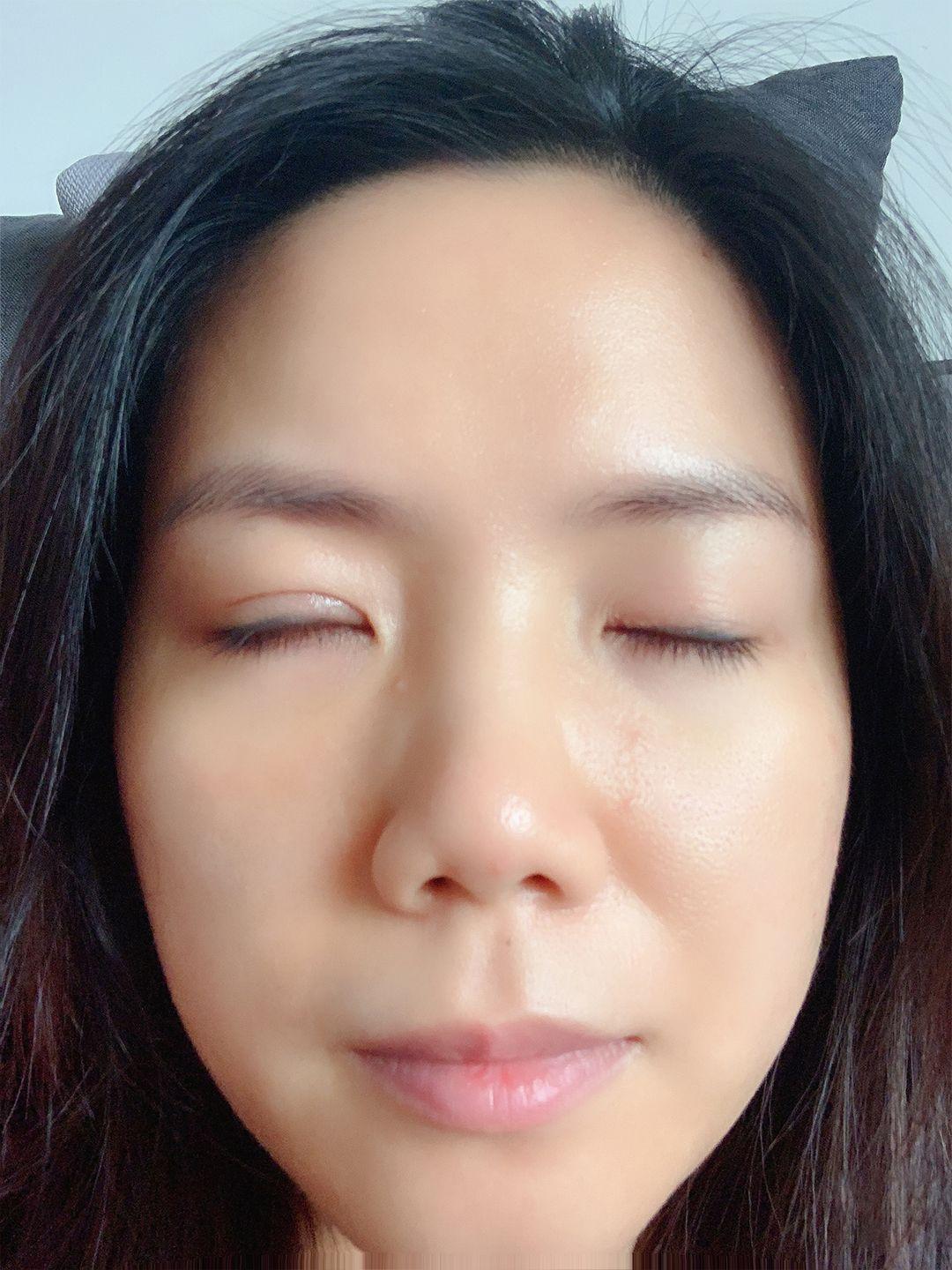上睑下垂矫正恢复记录。 8