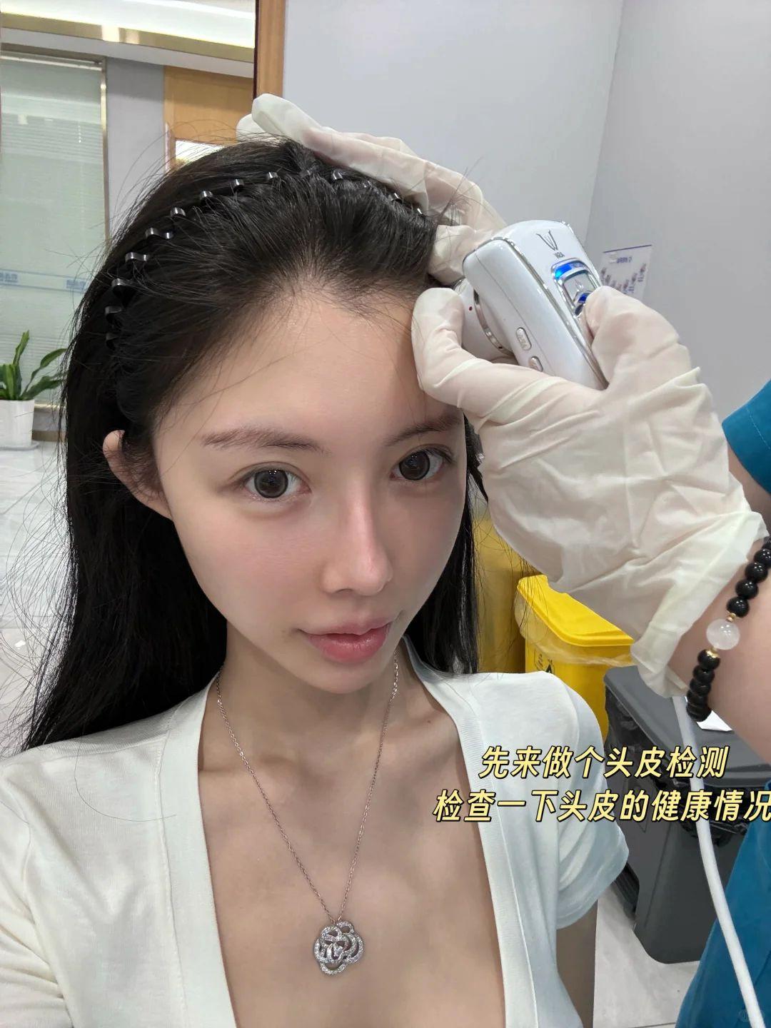  不剃发植发   植发手术