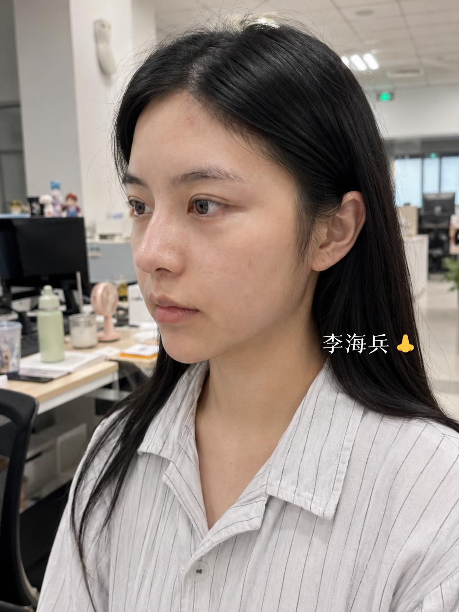 终于拆了，还有一点点淤青 1