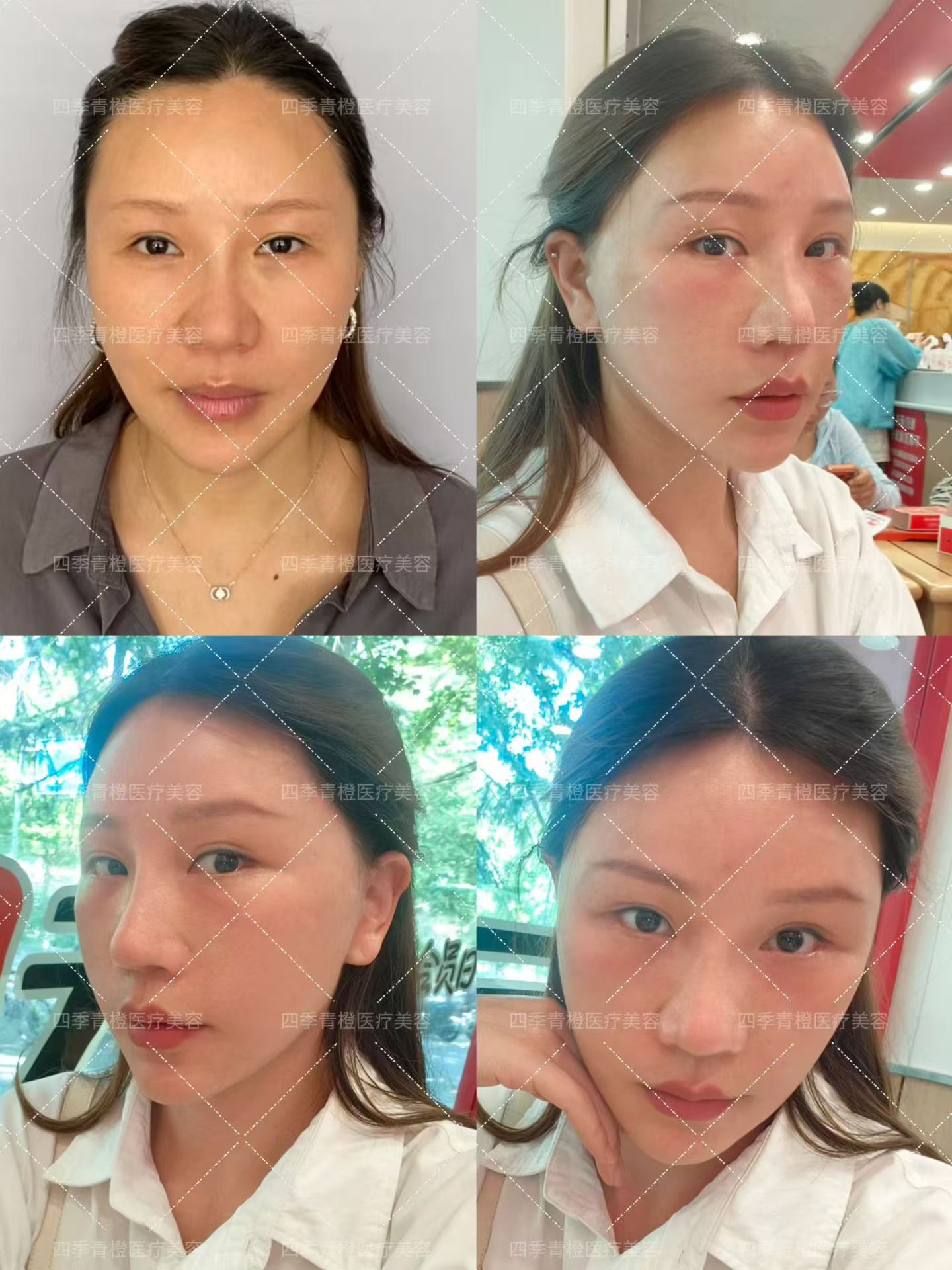 面部提升后一个月 1