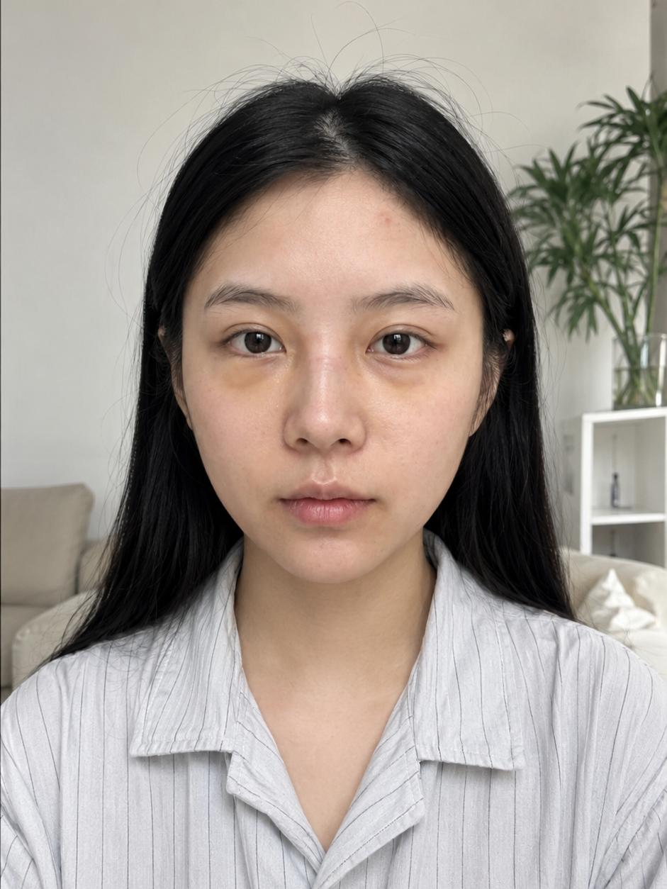 终于拆了，还有一点点淤青 2