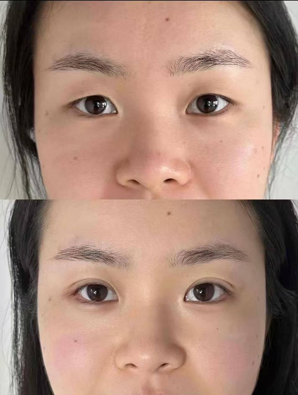 双眼皮拆线即刻 1