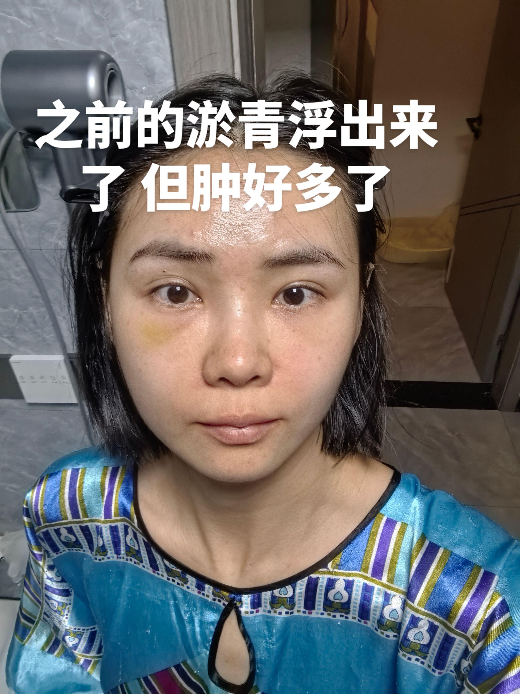 泪沟 9
