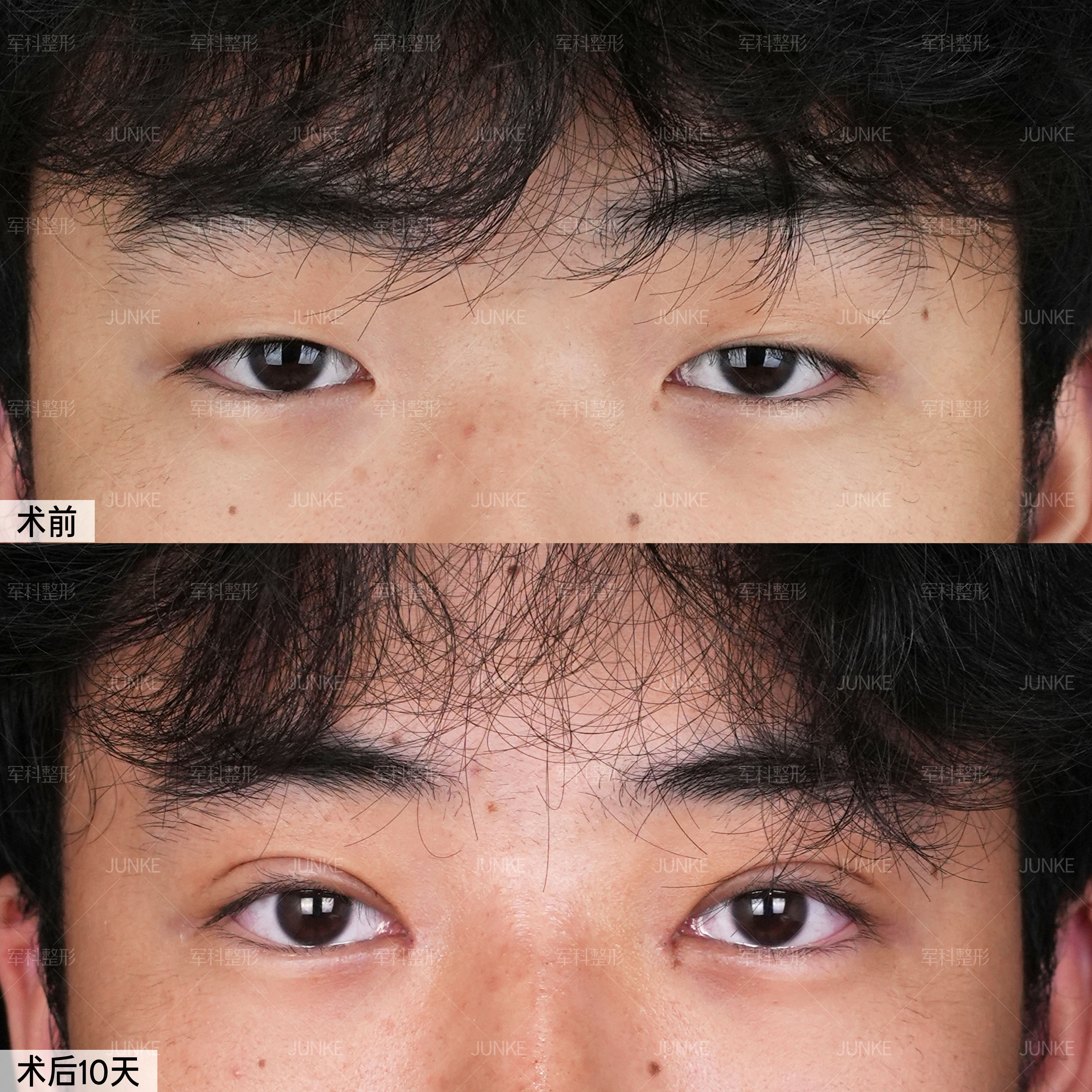 男士双眼皮术后10天 1